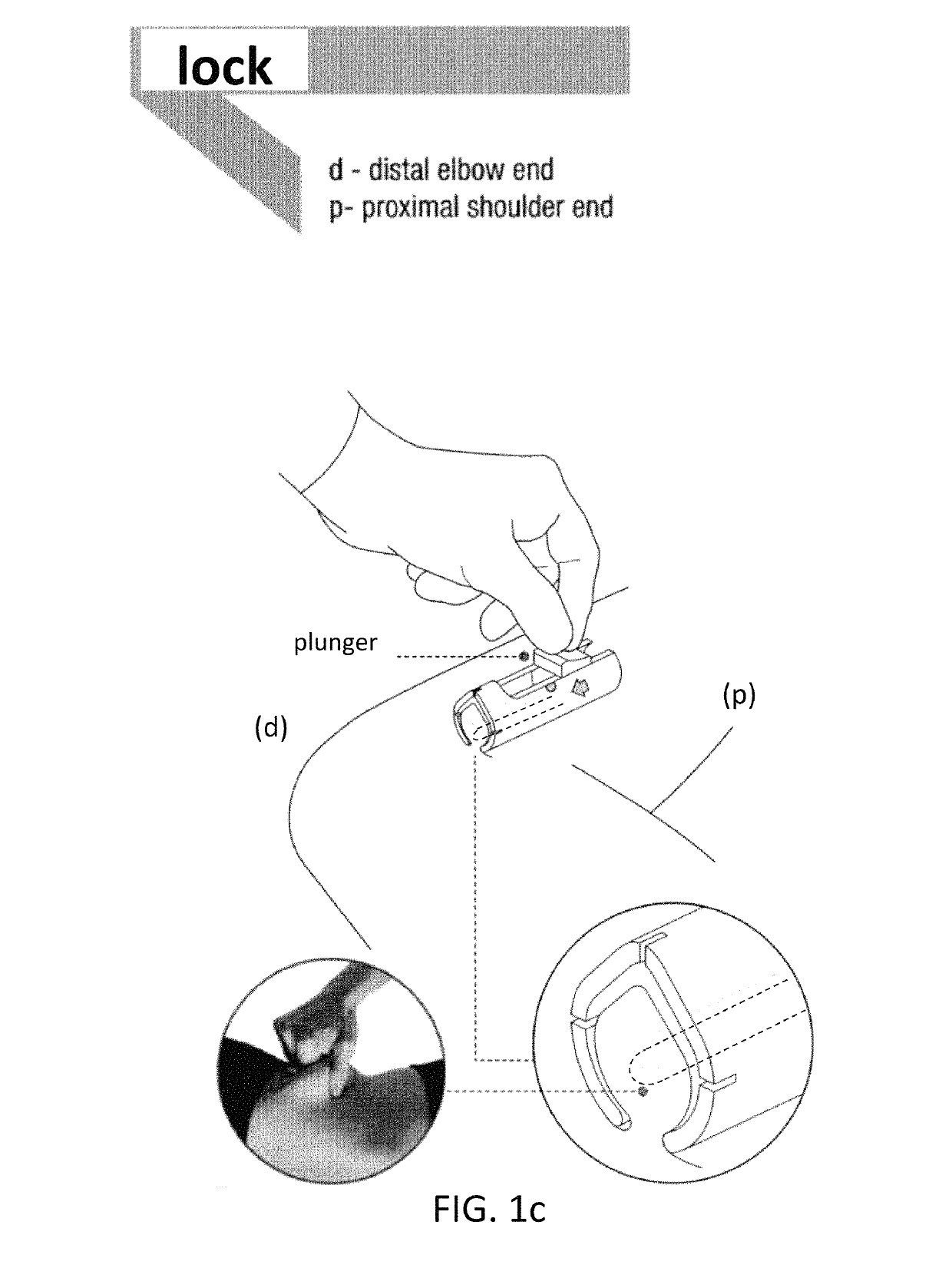 Device for removing an item implanted underneath the skin
