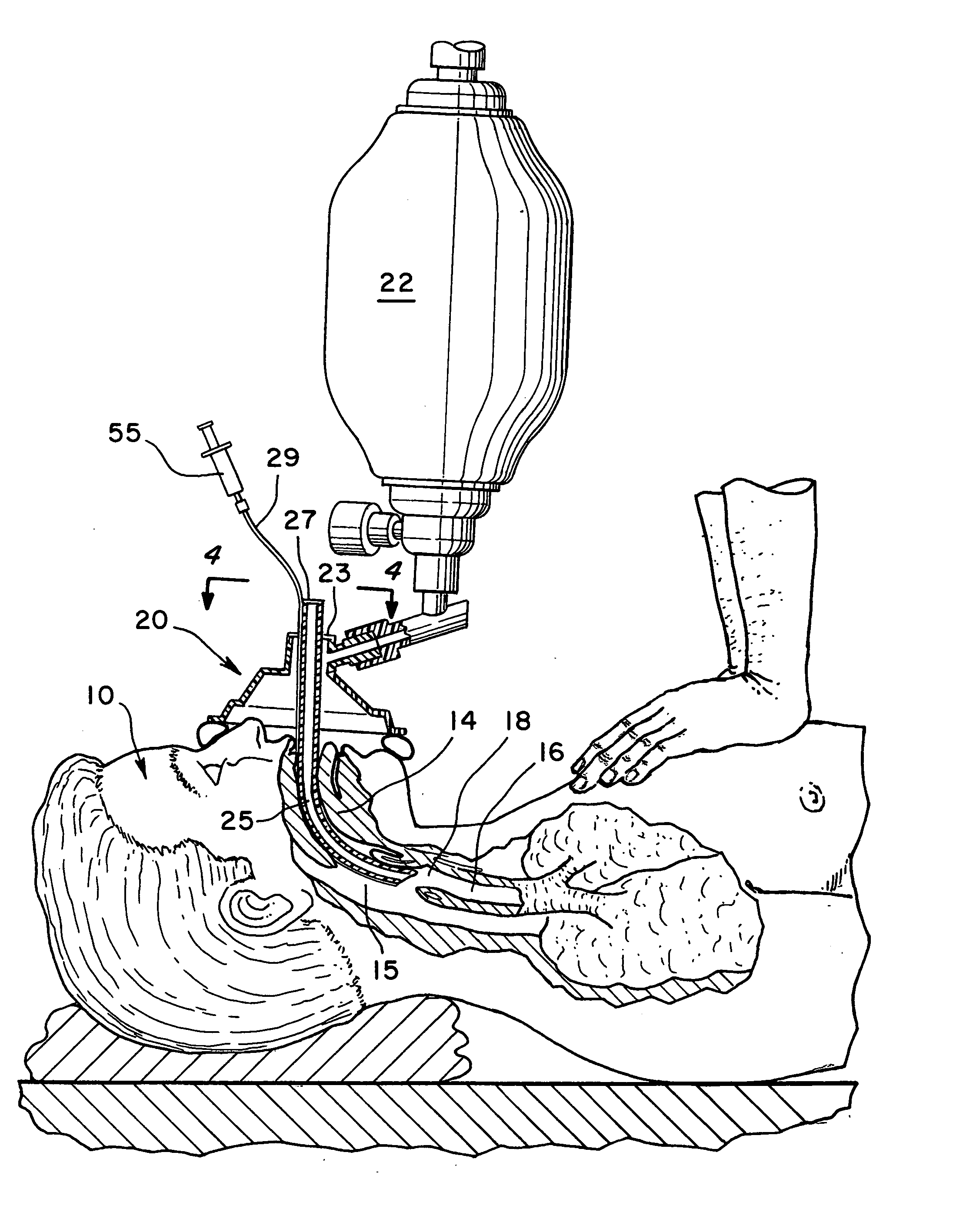 Method and apparatus for ventilation / oxygenation during guided insertion of an endotracheal tube