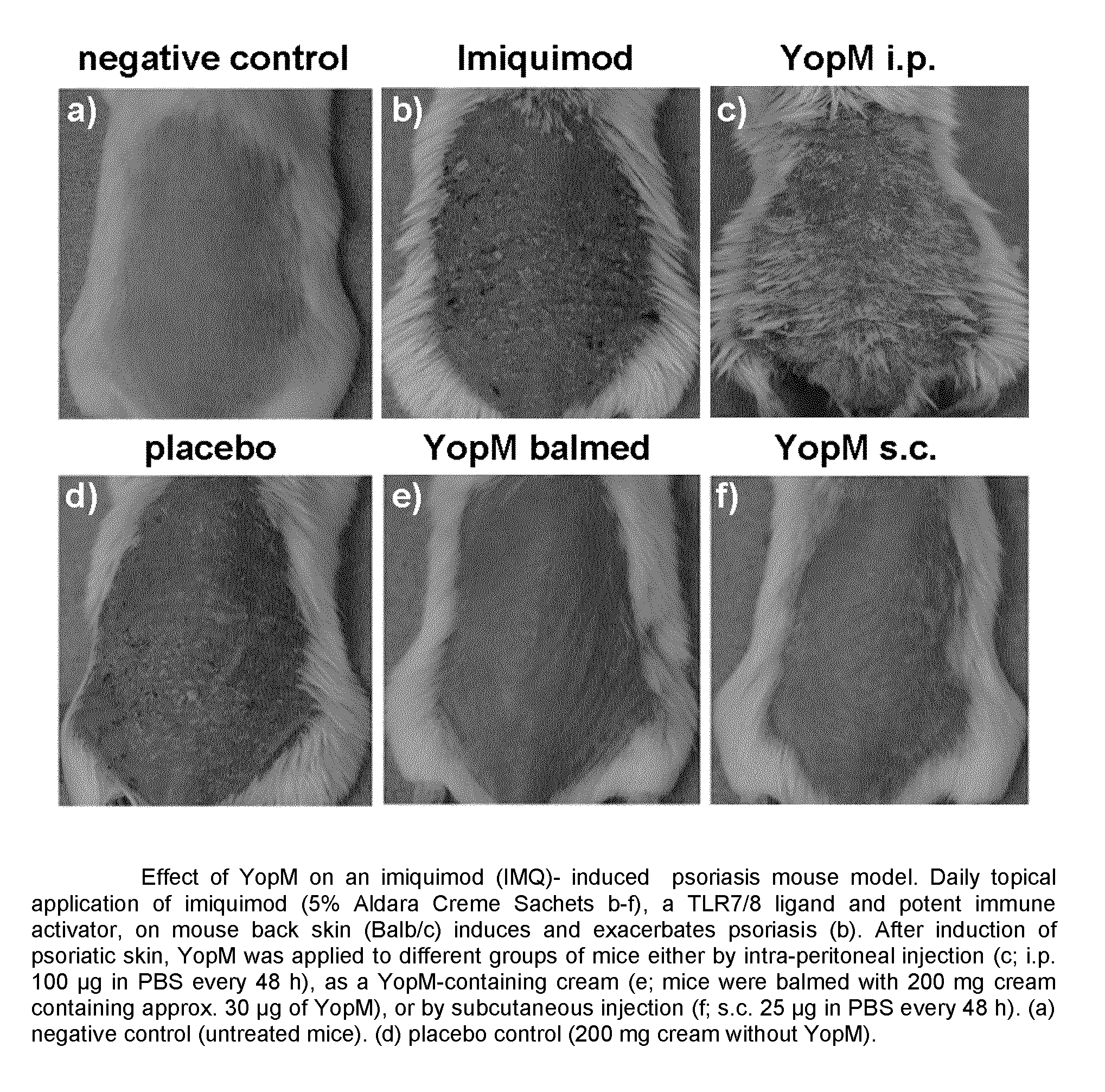 <i>Yersinia </i>outer protein M (YopM) in the treatment of psoriasis