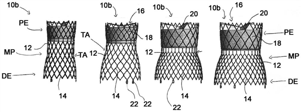 Self-expanding stent and stent set