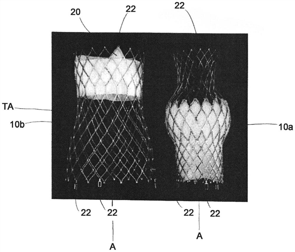 Self-expanding stent and stent set
