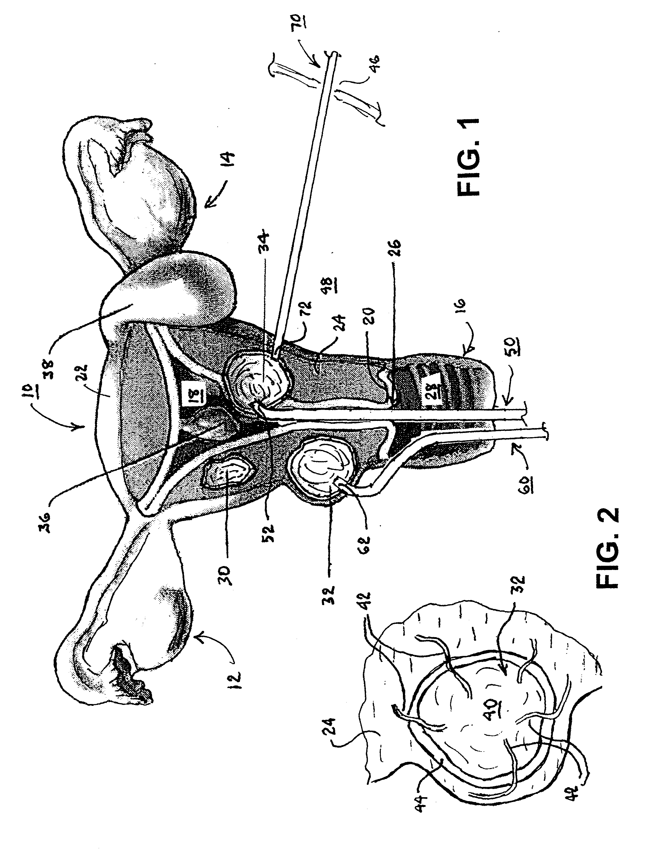 Methods and Apparatus for Treating Uterine Fibroids