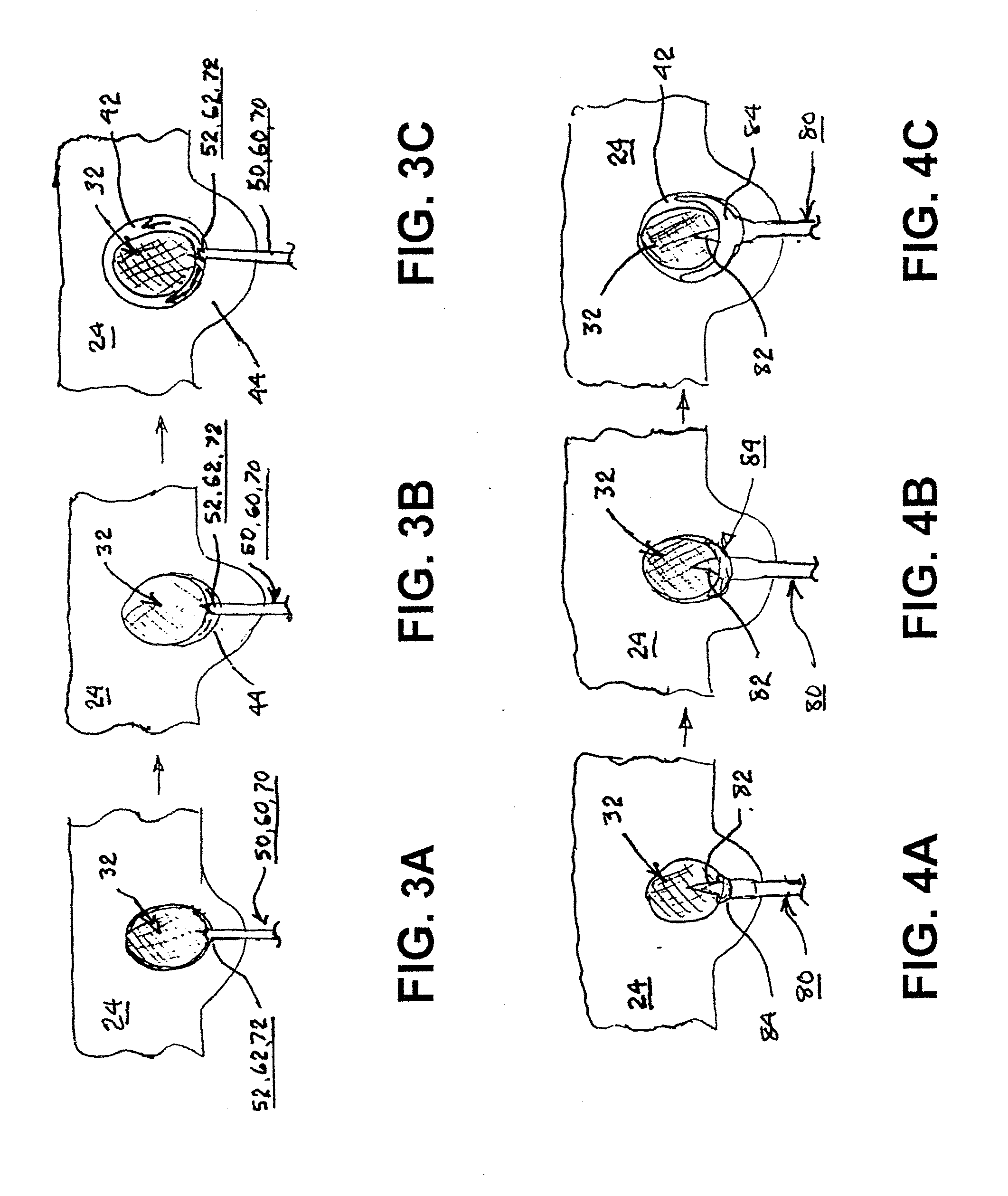 Methods and Apparatus for Treating Uterine Fibroids