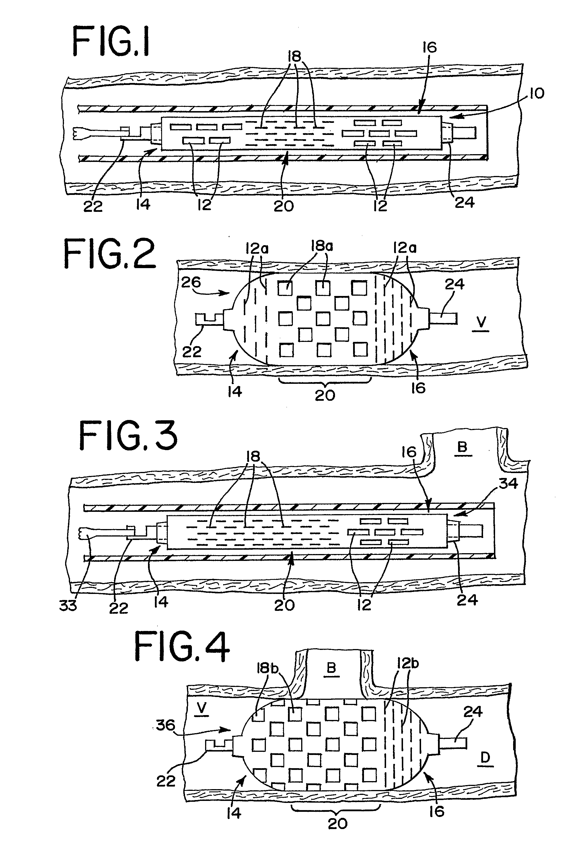Thin Film Devices for Temporary or Permanent Occlusion of a Vessel