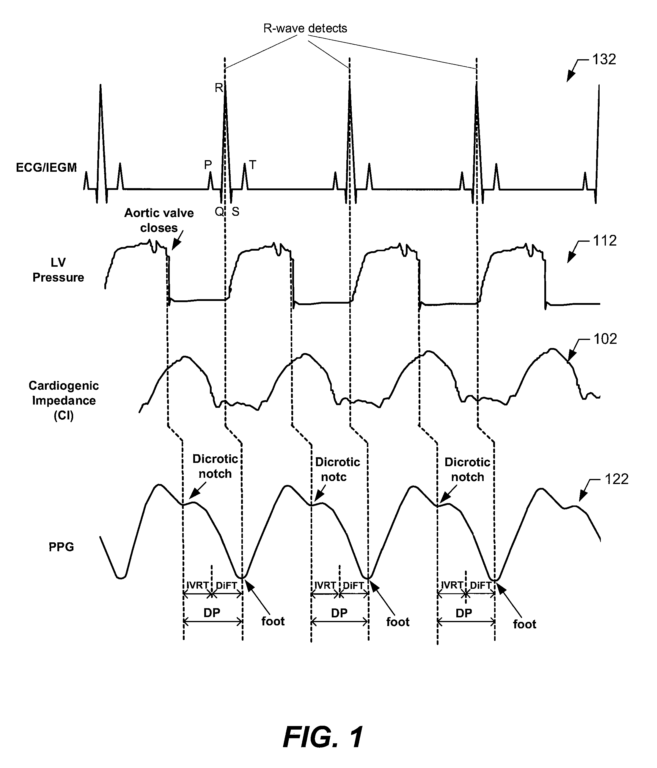 Systems and methods for monitoring DP, IVRT, DiFT, diastolic function and/or HF