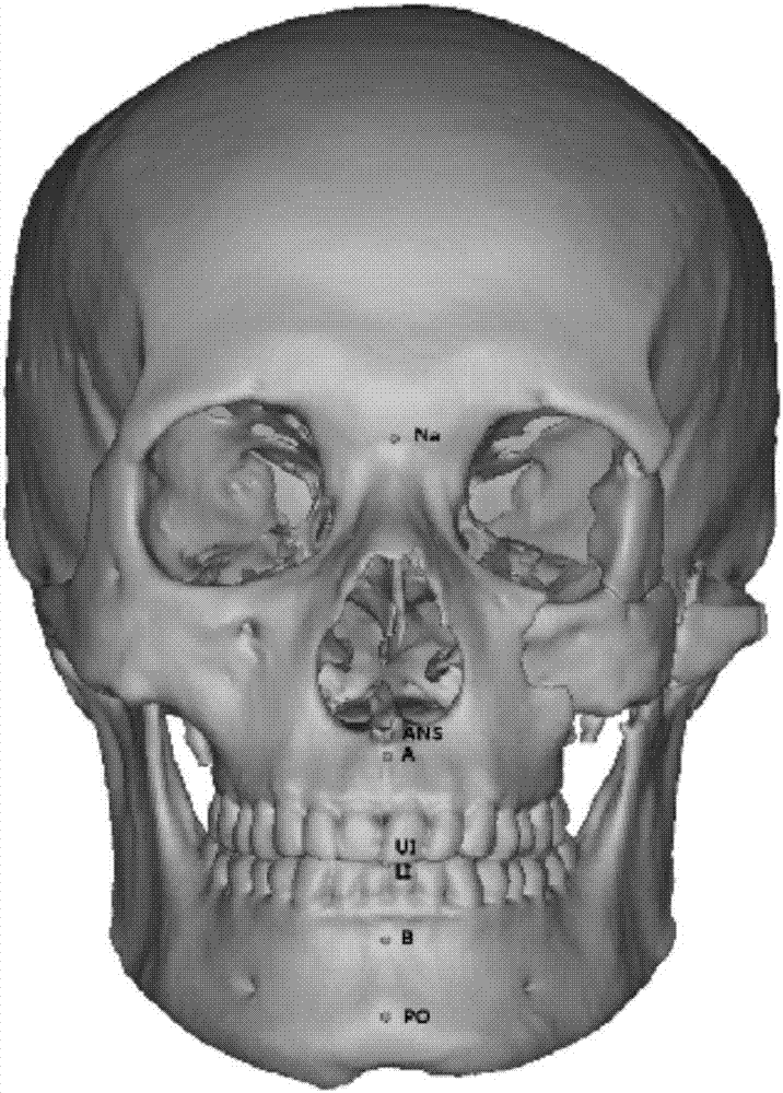 Method for establishing standard median sagittal plane by applying bone markers for craniofacial deformity