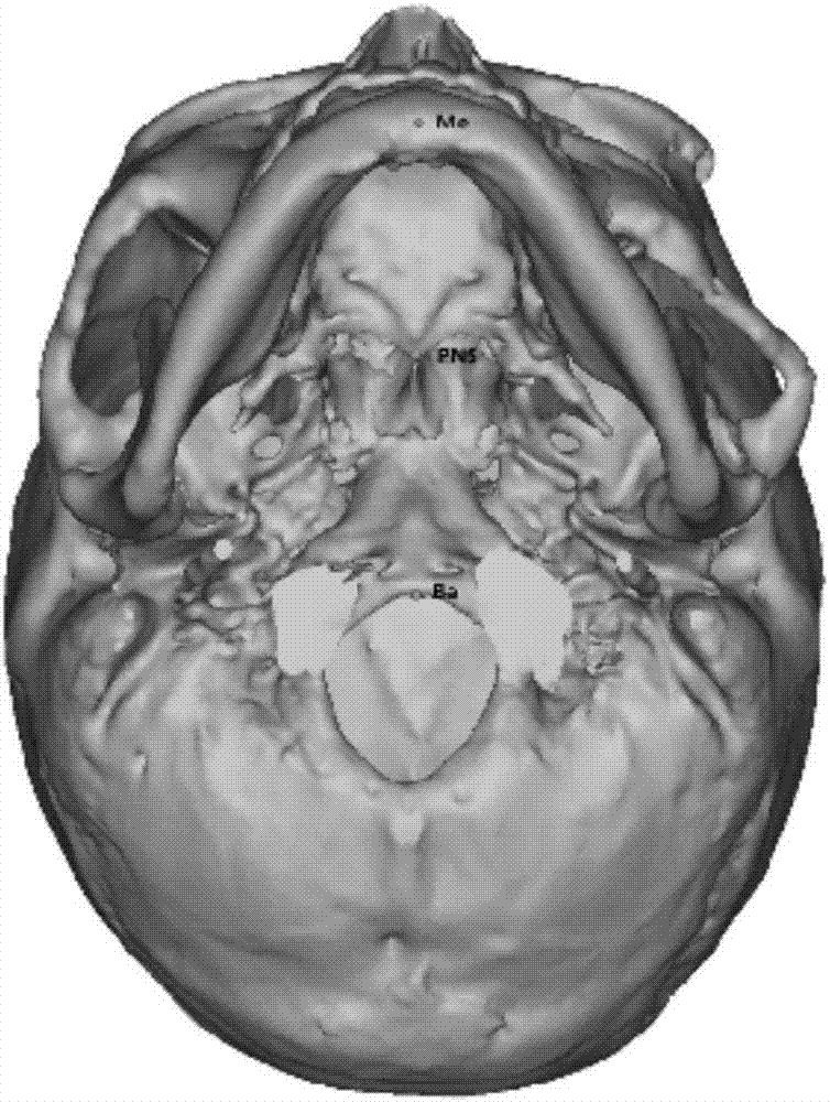 Method for establishing standard median sagittal plane by applying bone markers for craniofacial deformity