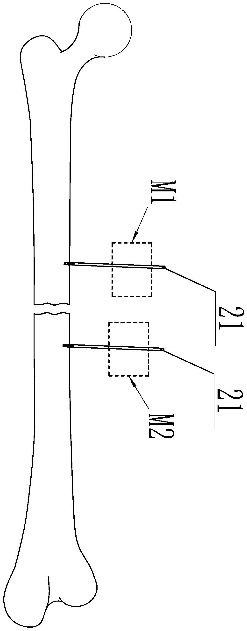 Fracture tractive reduction device