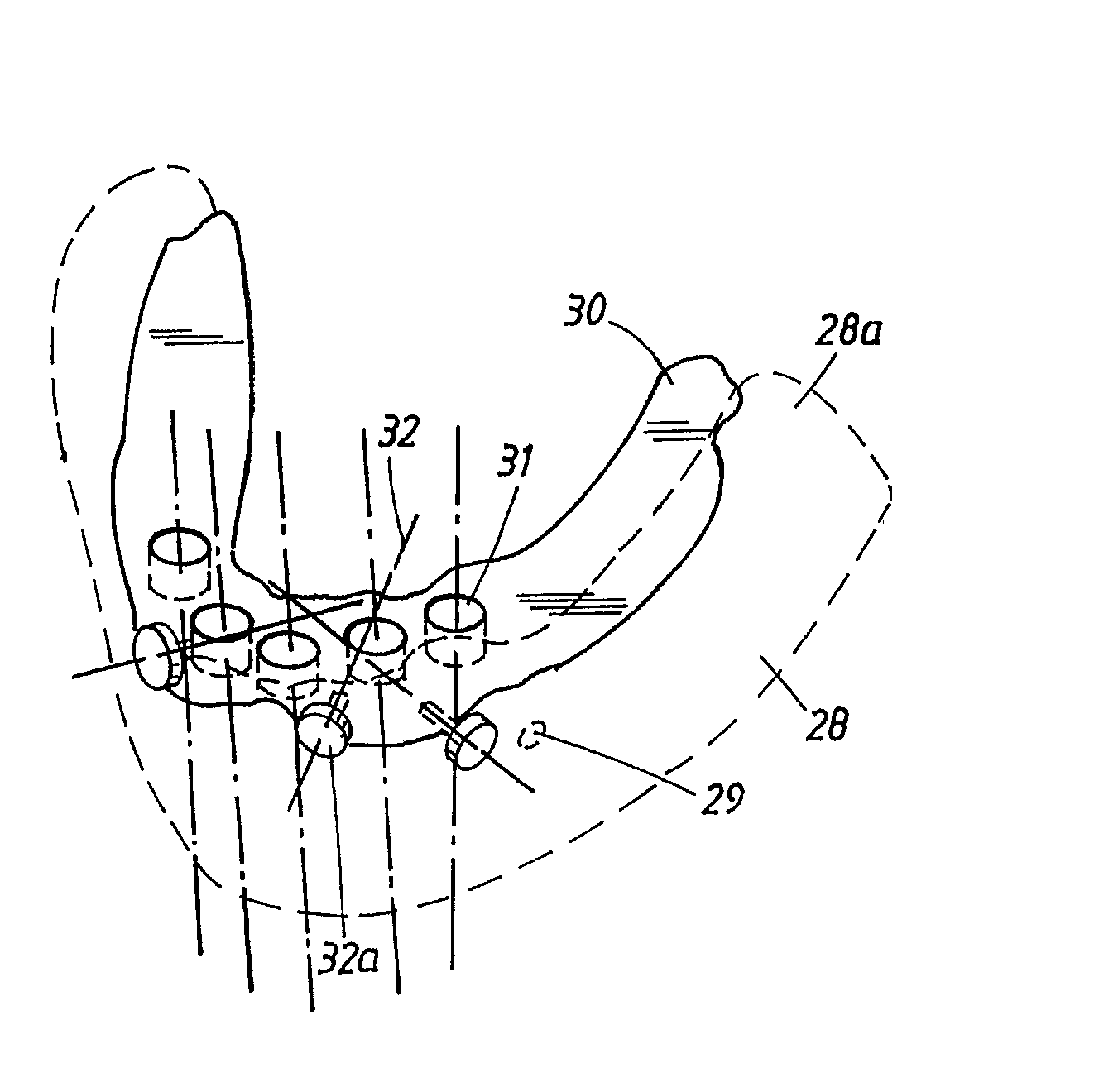 Arrangement and device for using a template to form holes for implants in bone, preferably jaw bone
