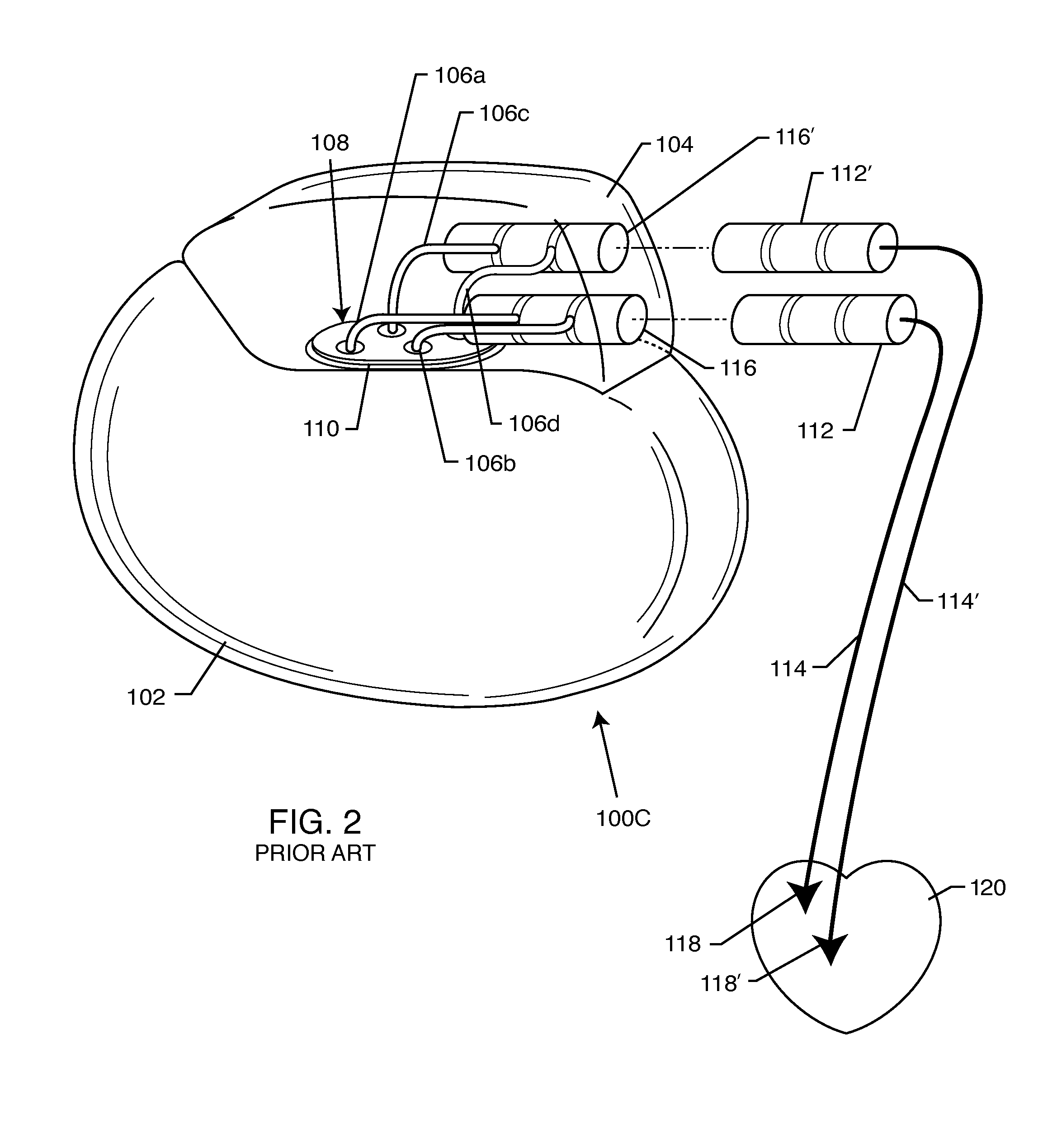 Multilayer helical wave filter for medical therapeutic or diagnostic applications