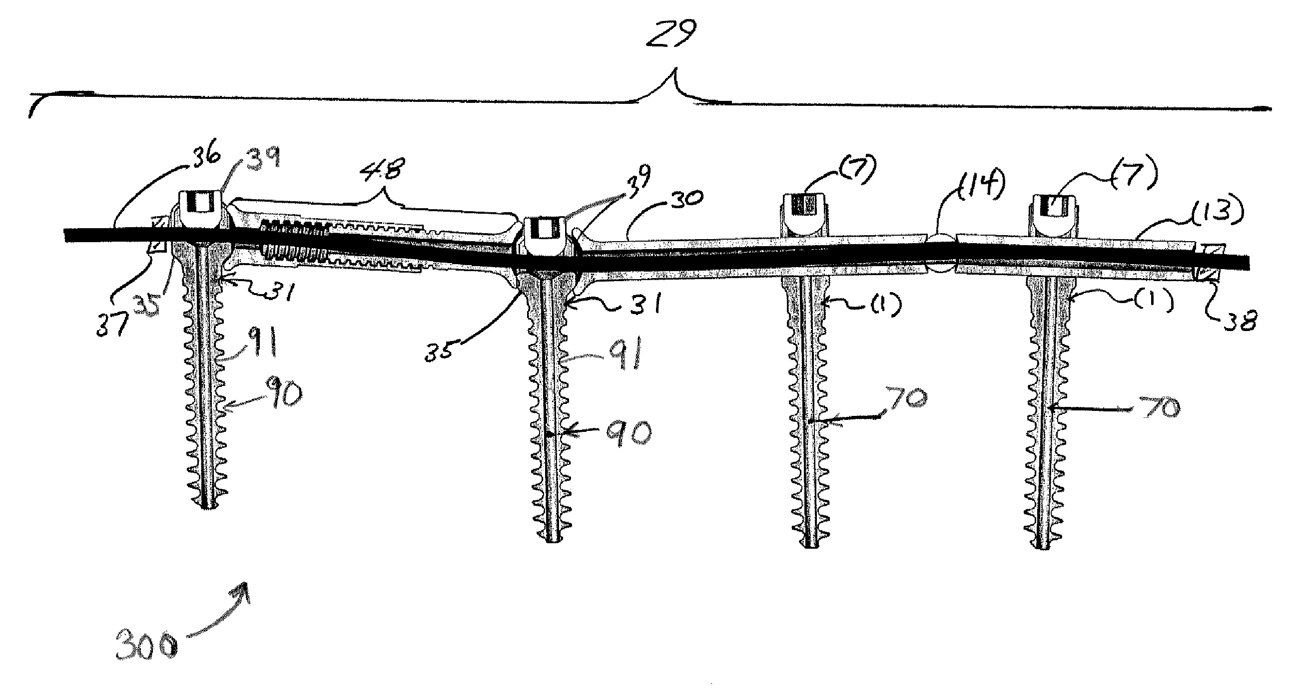 Spinal Rod System