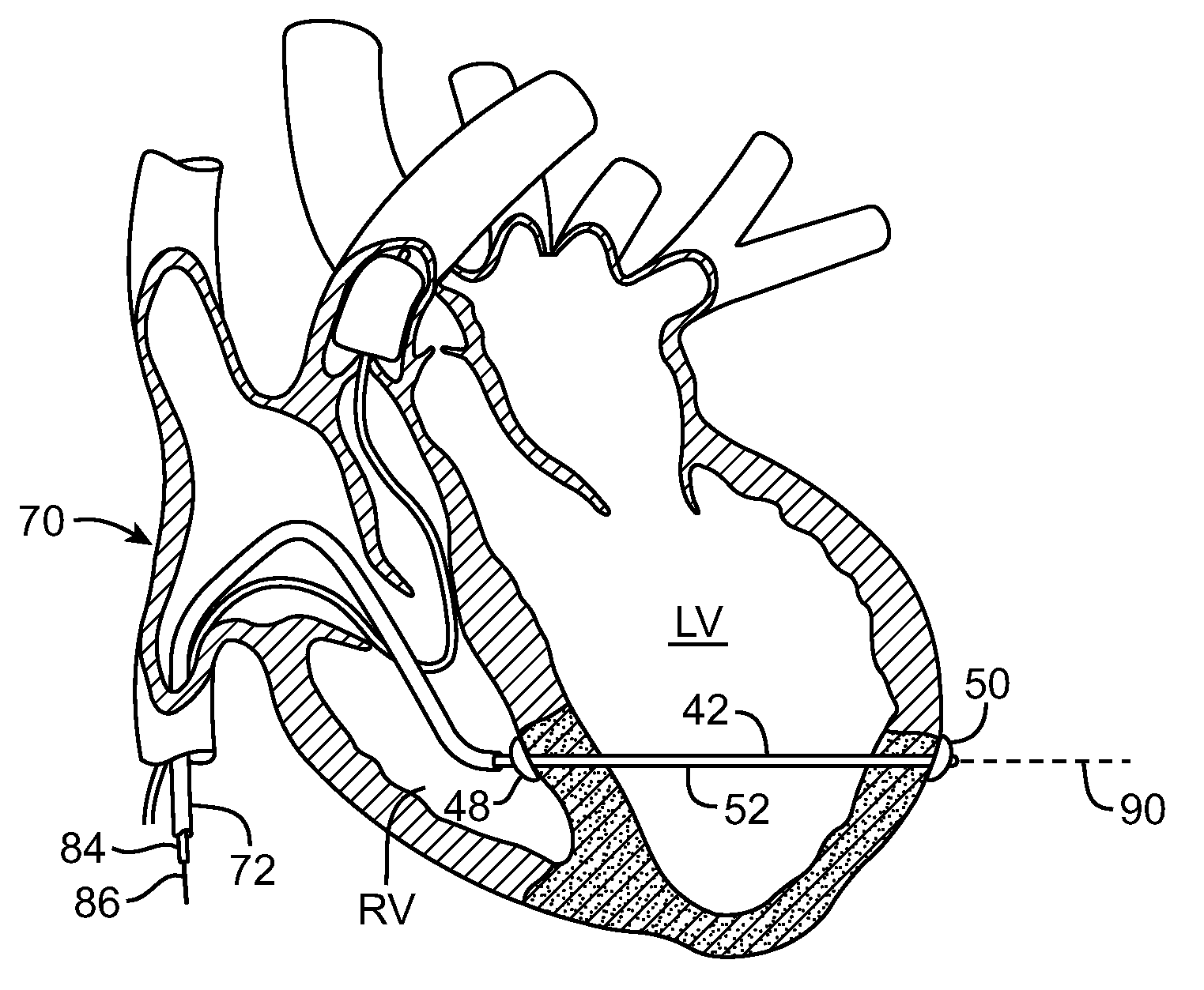 Signal Transmitting and Lesion Excluding Heart Implants for Pacing Defibrillating and/or Sensing of Heart Beat