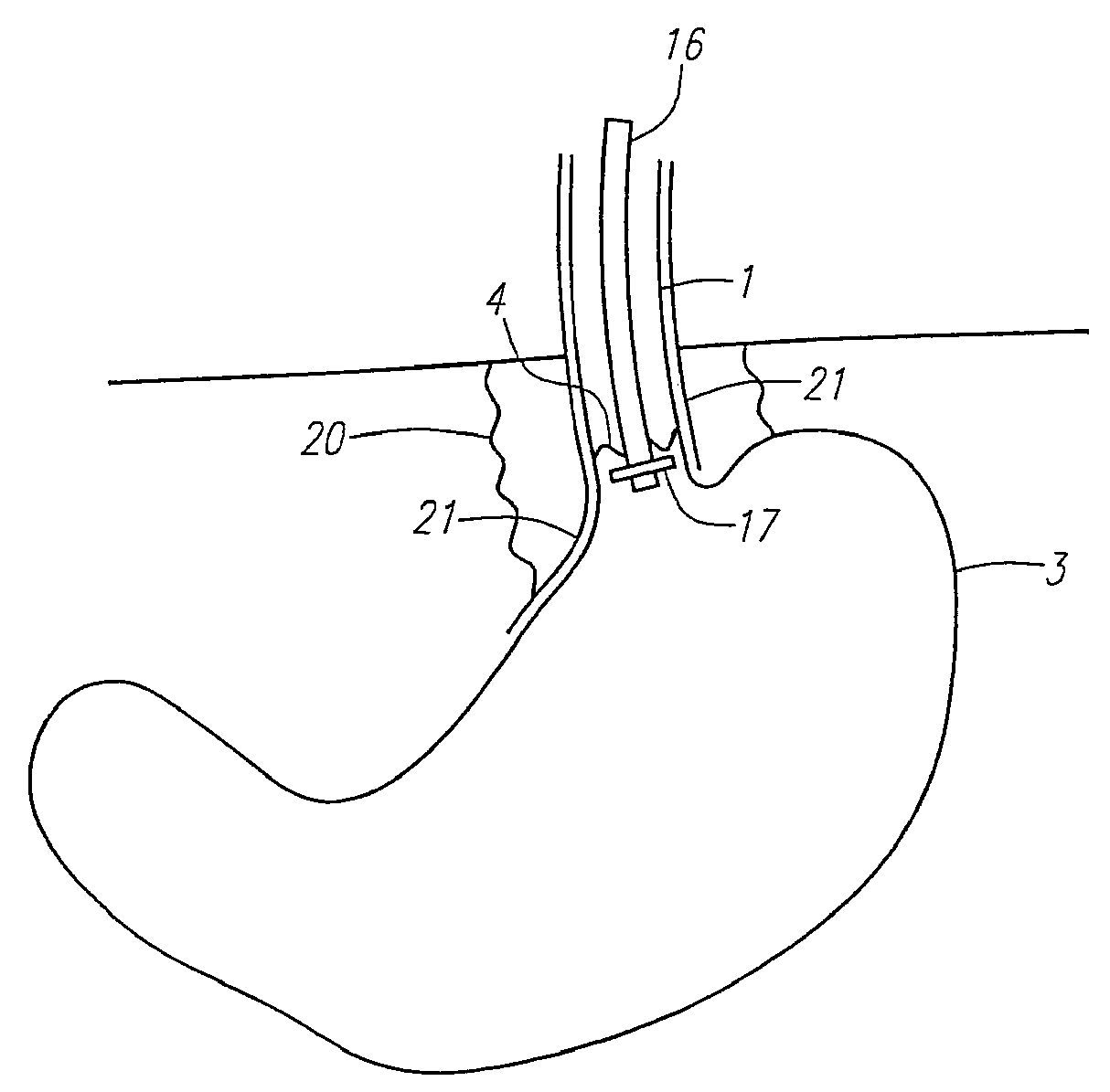 Methods and apparatus for treatment of obesity
