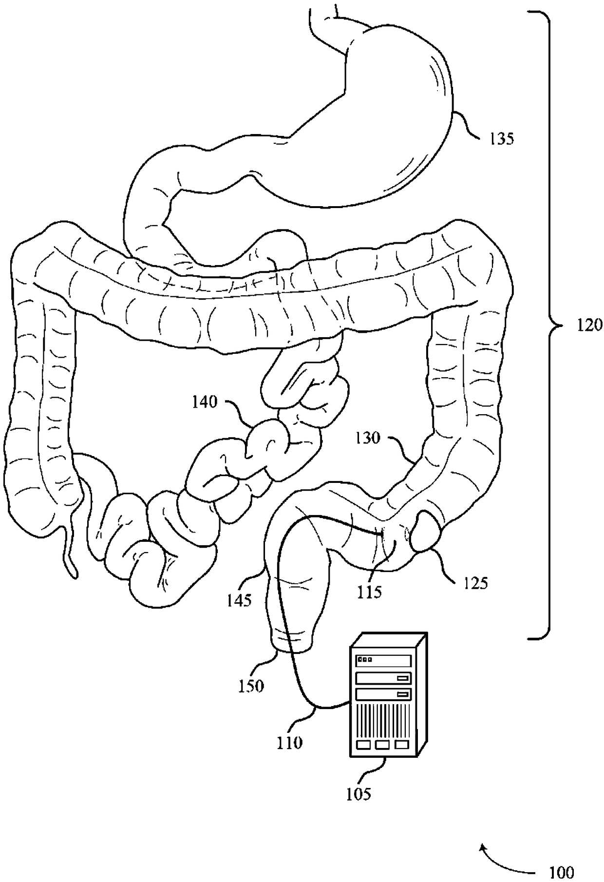Systems and methods for ablative treatment of irritable bowel disease