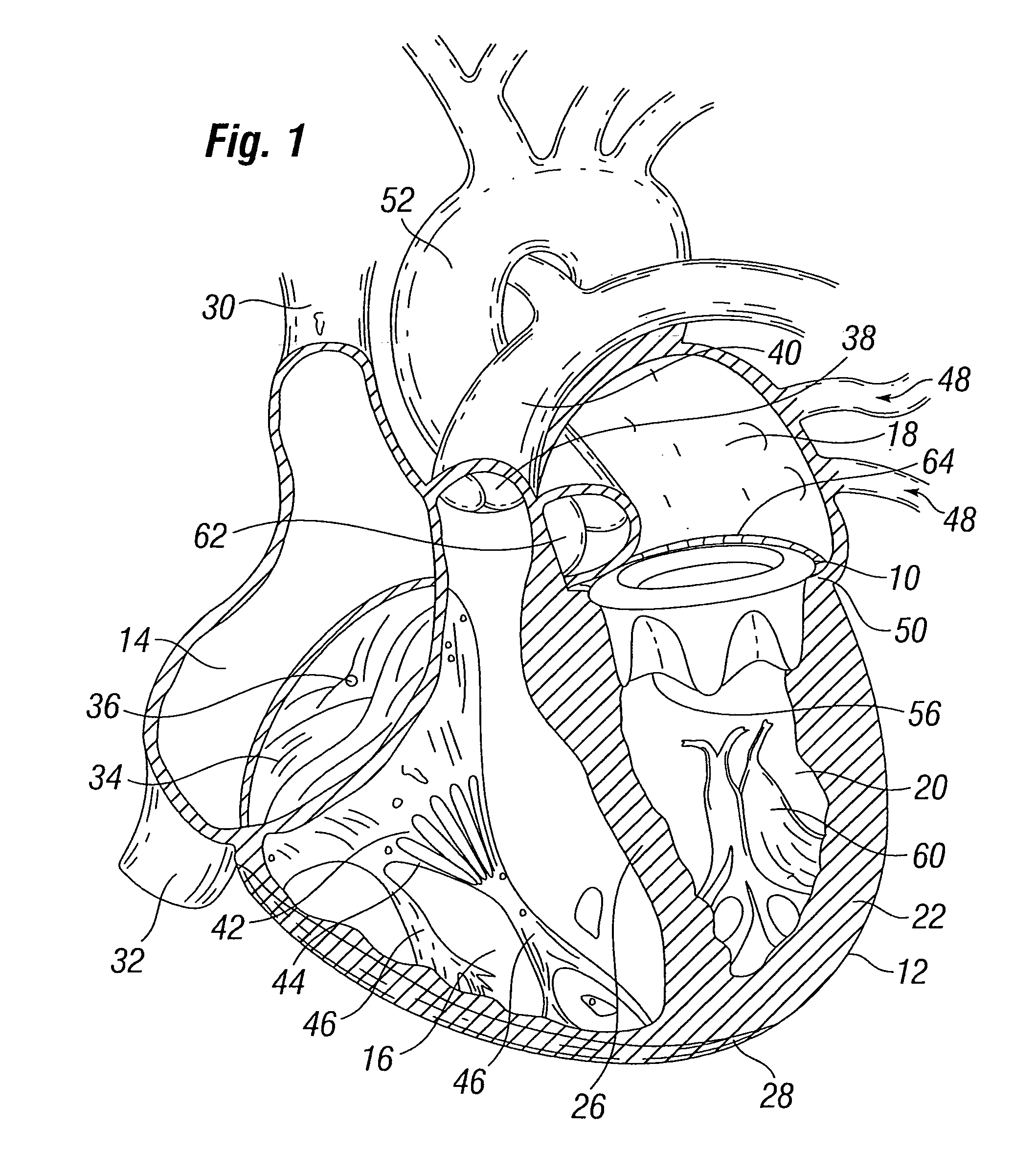 Prosthetic heart valve configured to receive a percutaneous prosthetic heart valve implantation