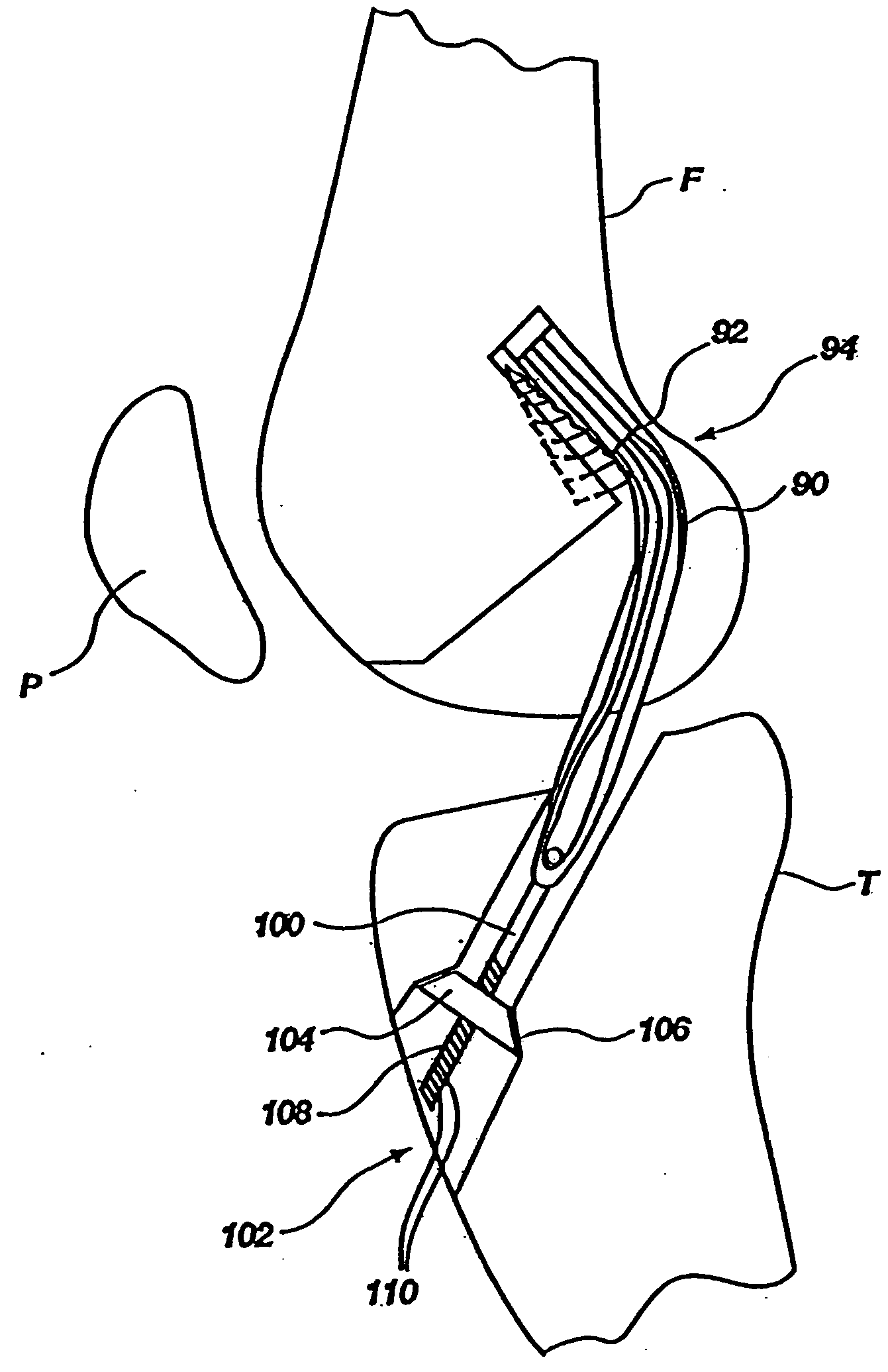 Endosteal tibial ligament fixation with adjustable tensioning