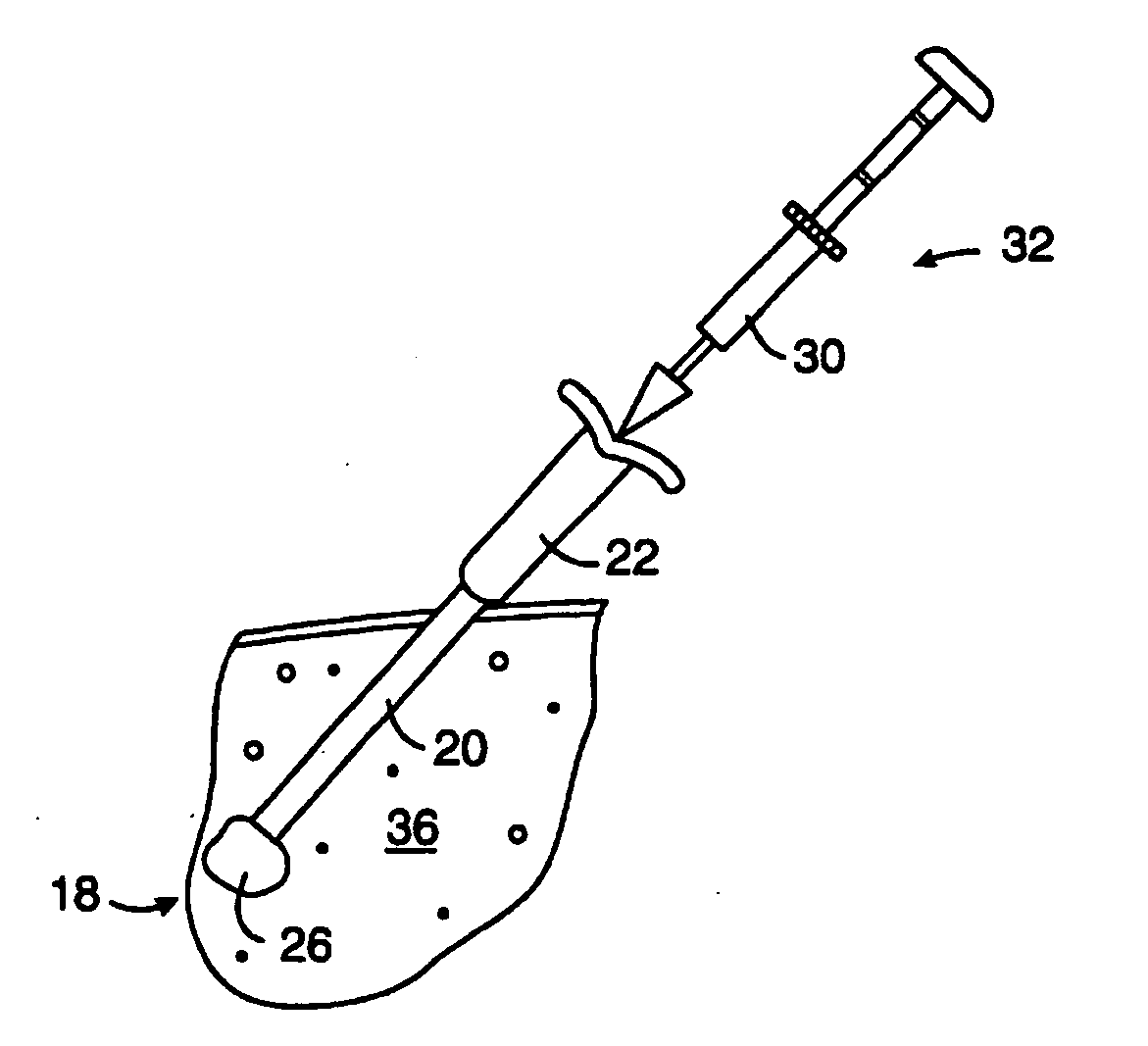 Biopsy localization method and device