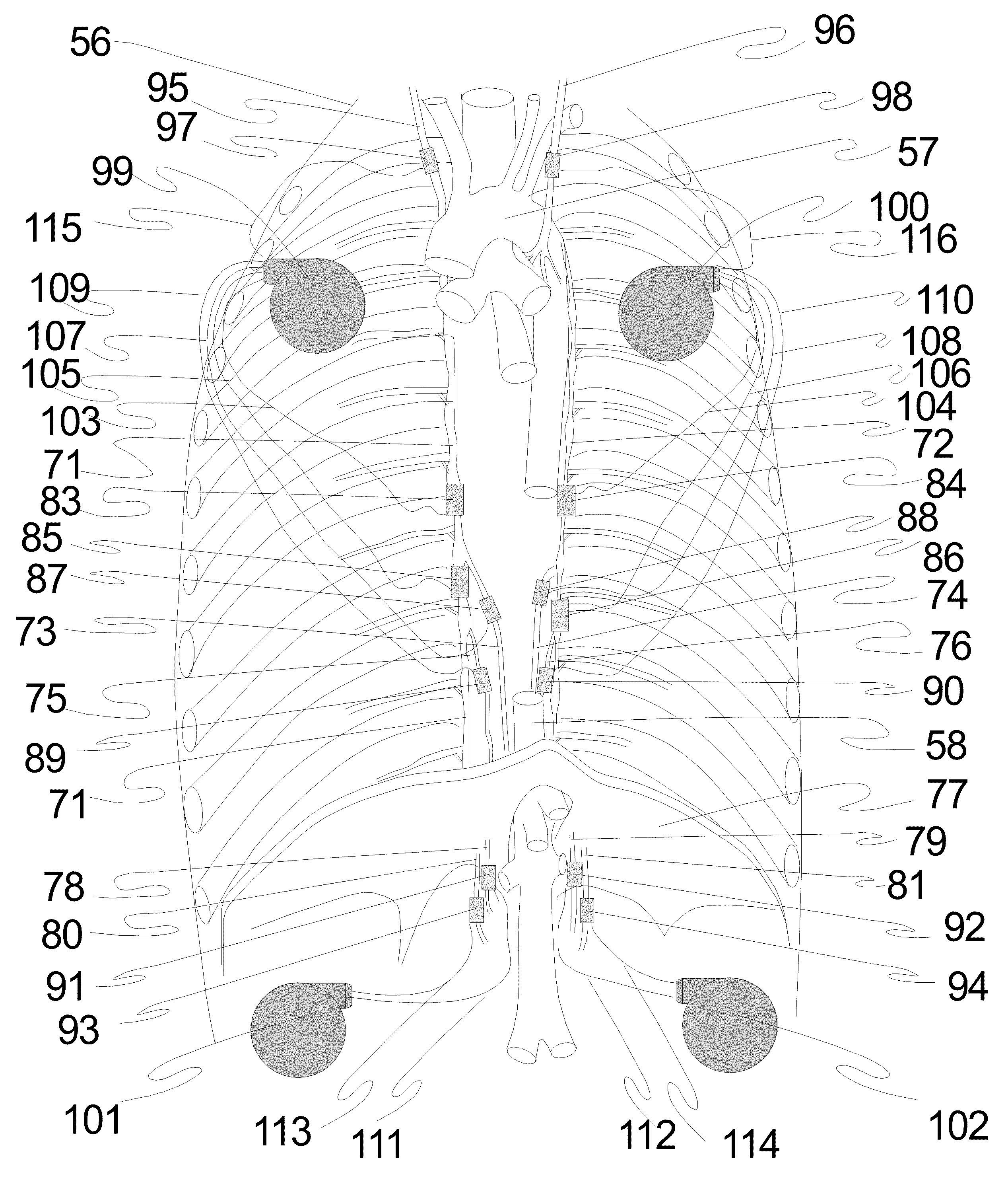 Apparatus for autonomic neuromodulation for the treatment of systemic disease