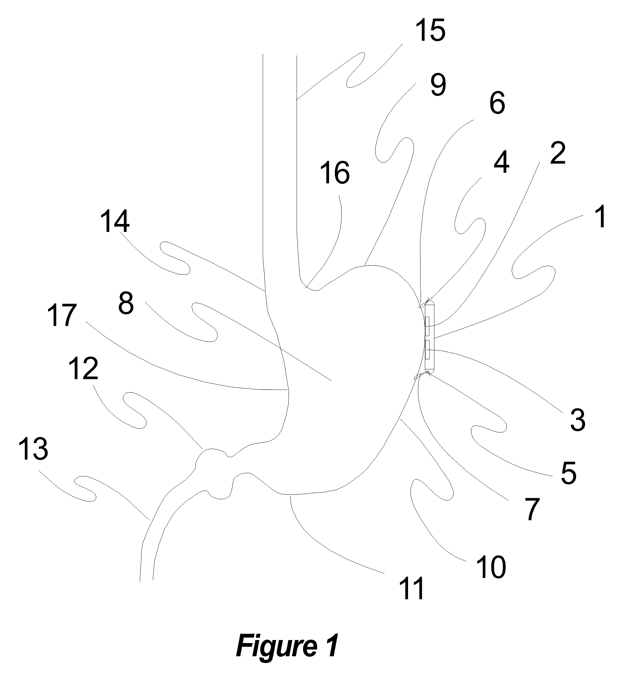 Apparatus for autonomic neuromodulation for the treatment of systemic disease