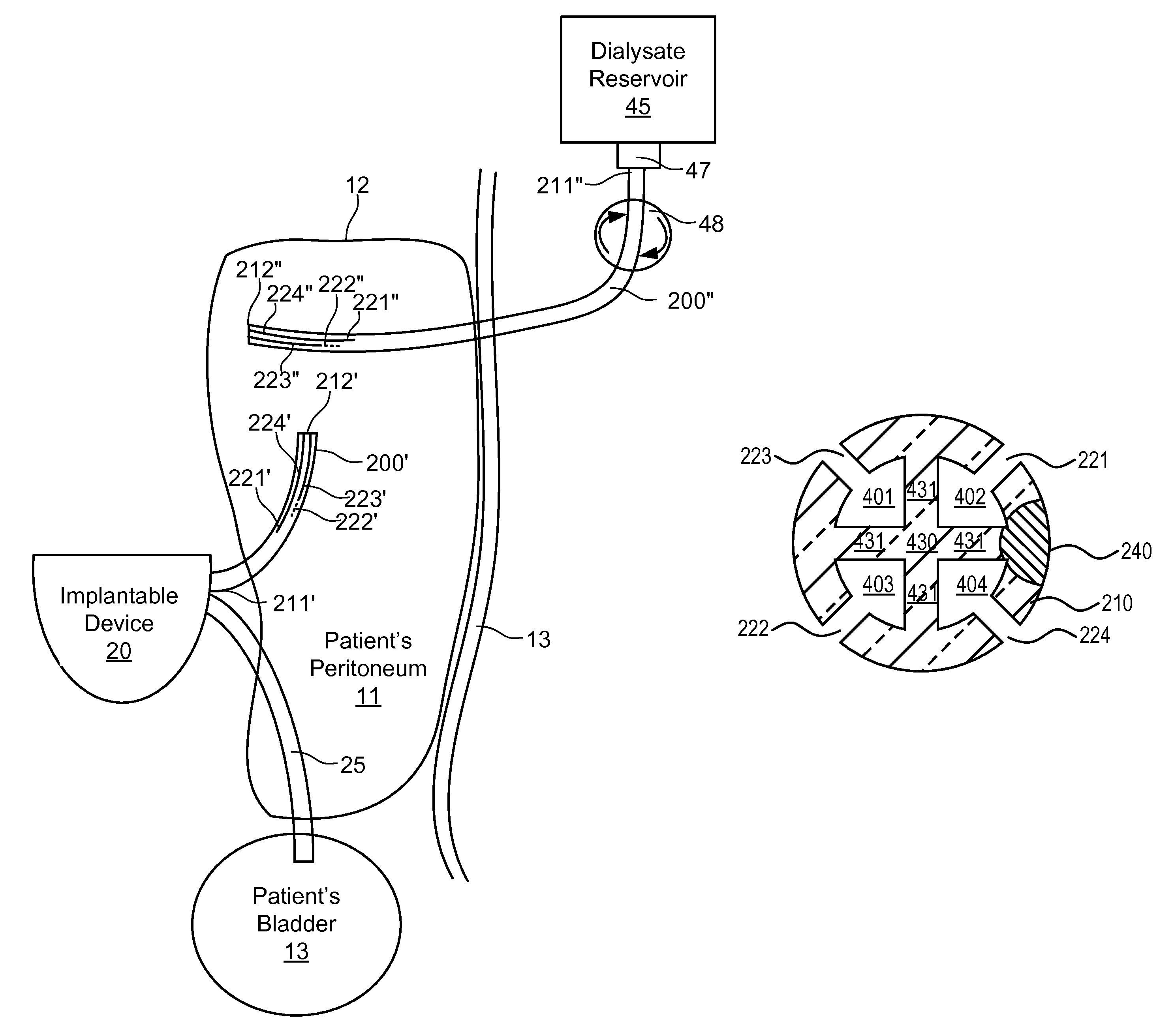 Implantable catheters with staggered slits, and methods of using same