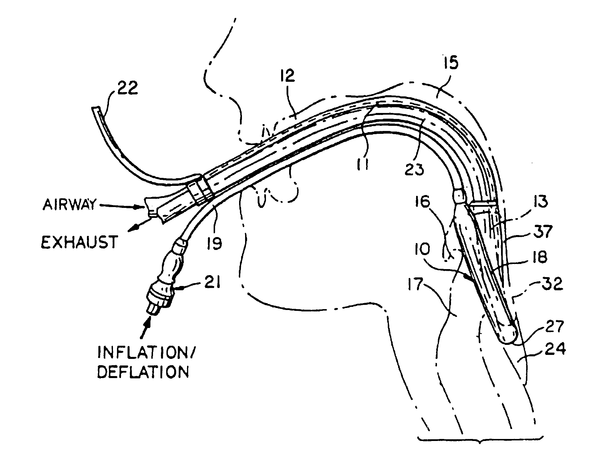 Gastro-laryngeal mask