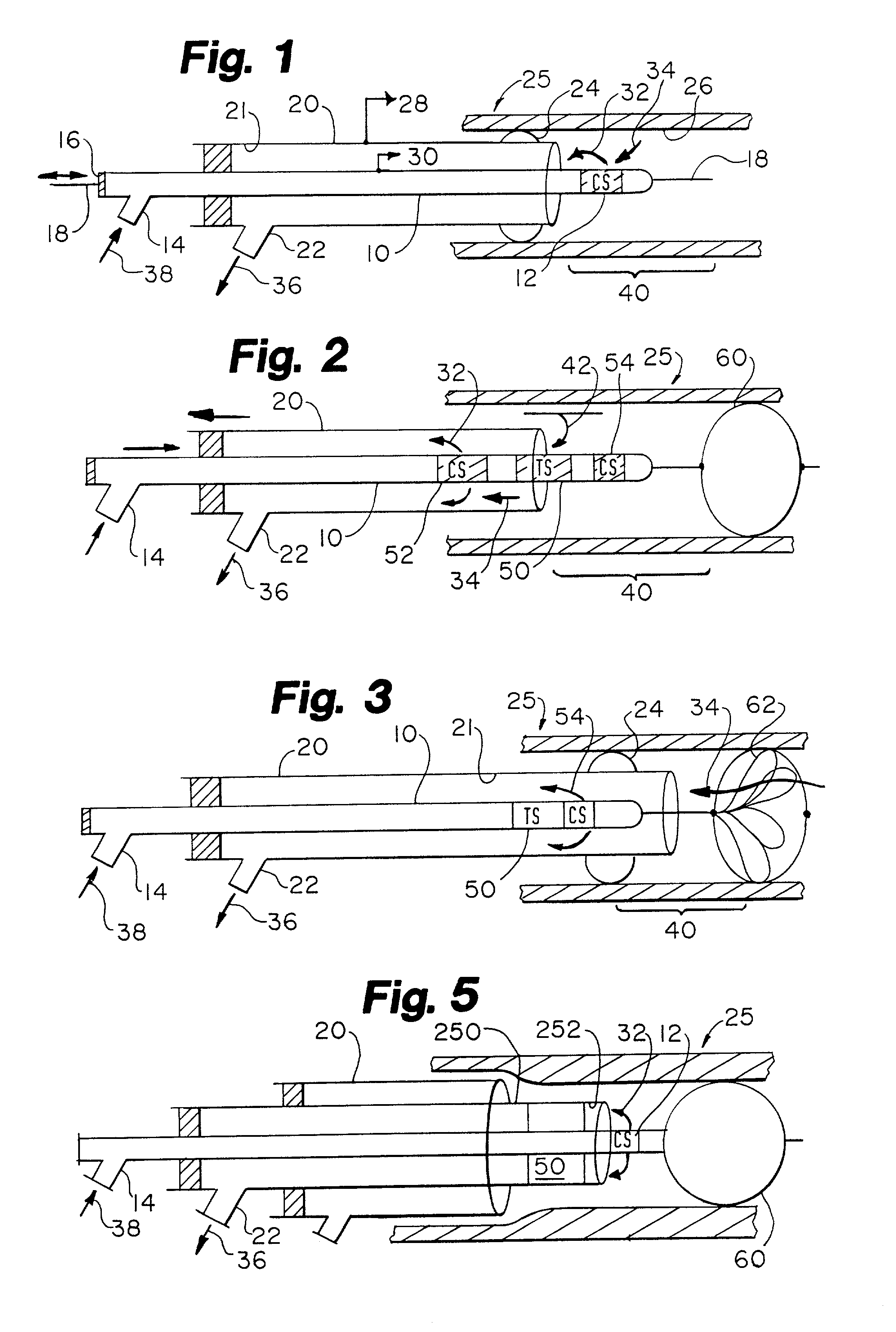 Fluidic interventional device and method of distal protection