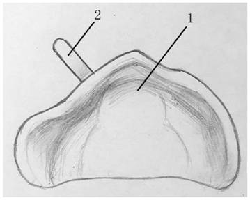 A digital manufacturing method of cleft lip and palate alveolar plastic palate guard