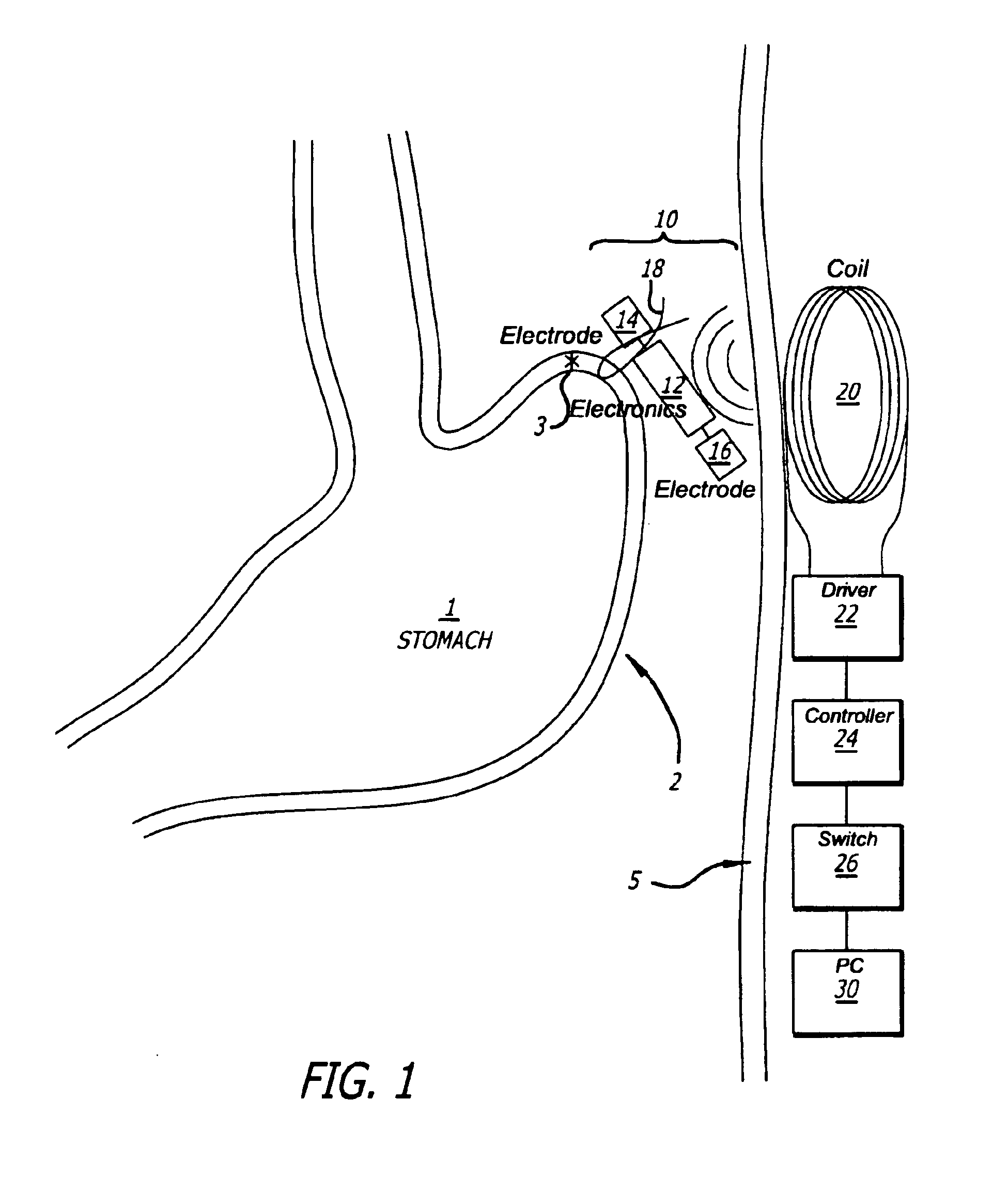 Method and apparatus to treat disorders of gastrointestinal peristalsis