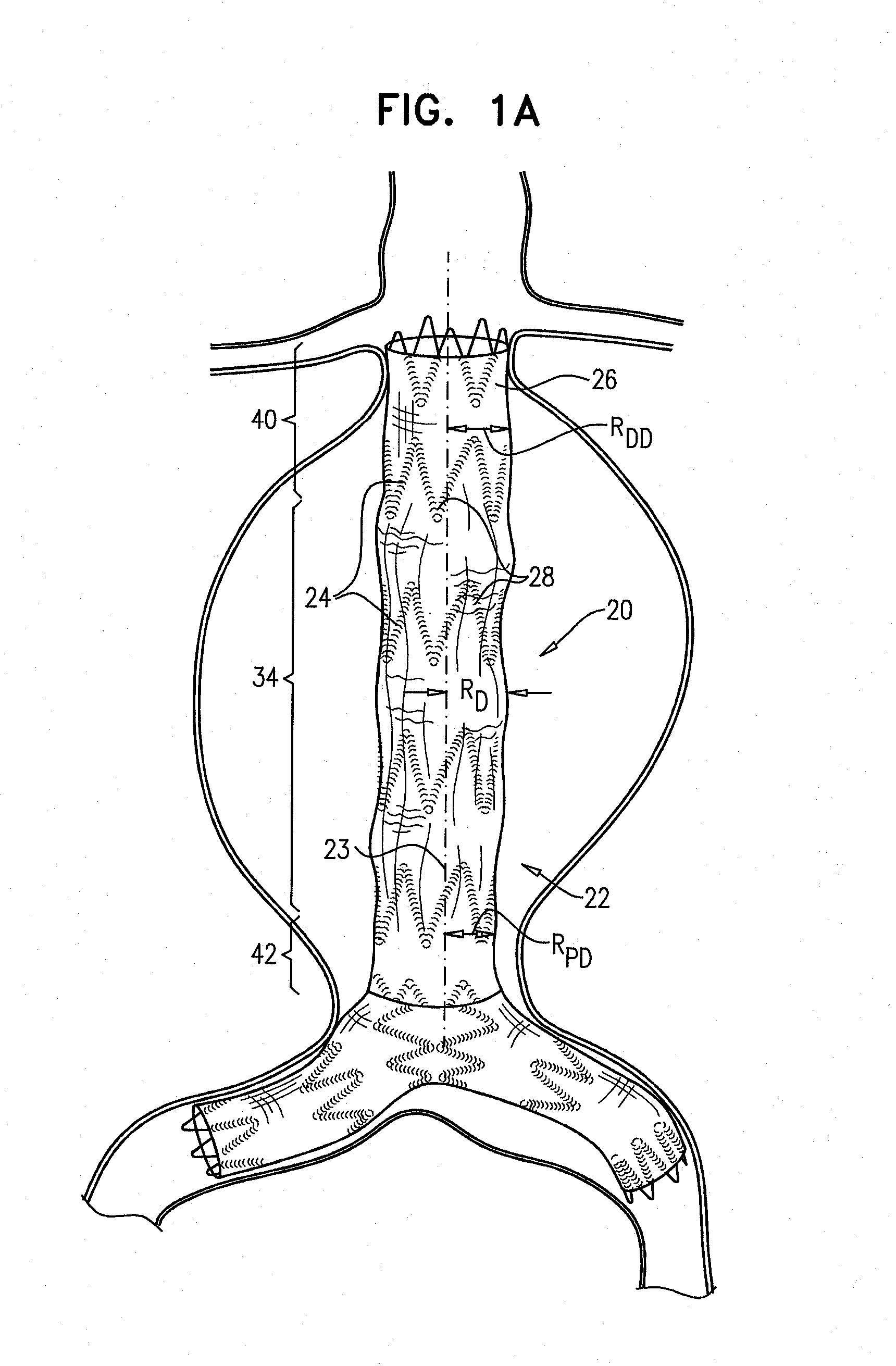 Stent-grafts with post-deployment variable radial displacement