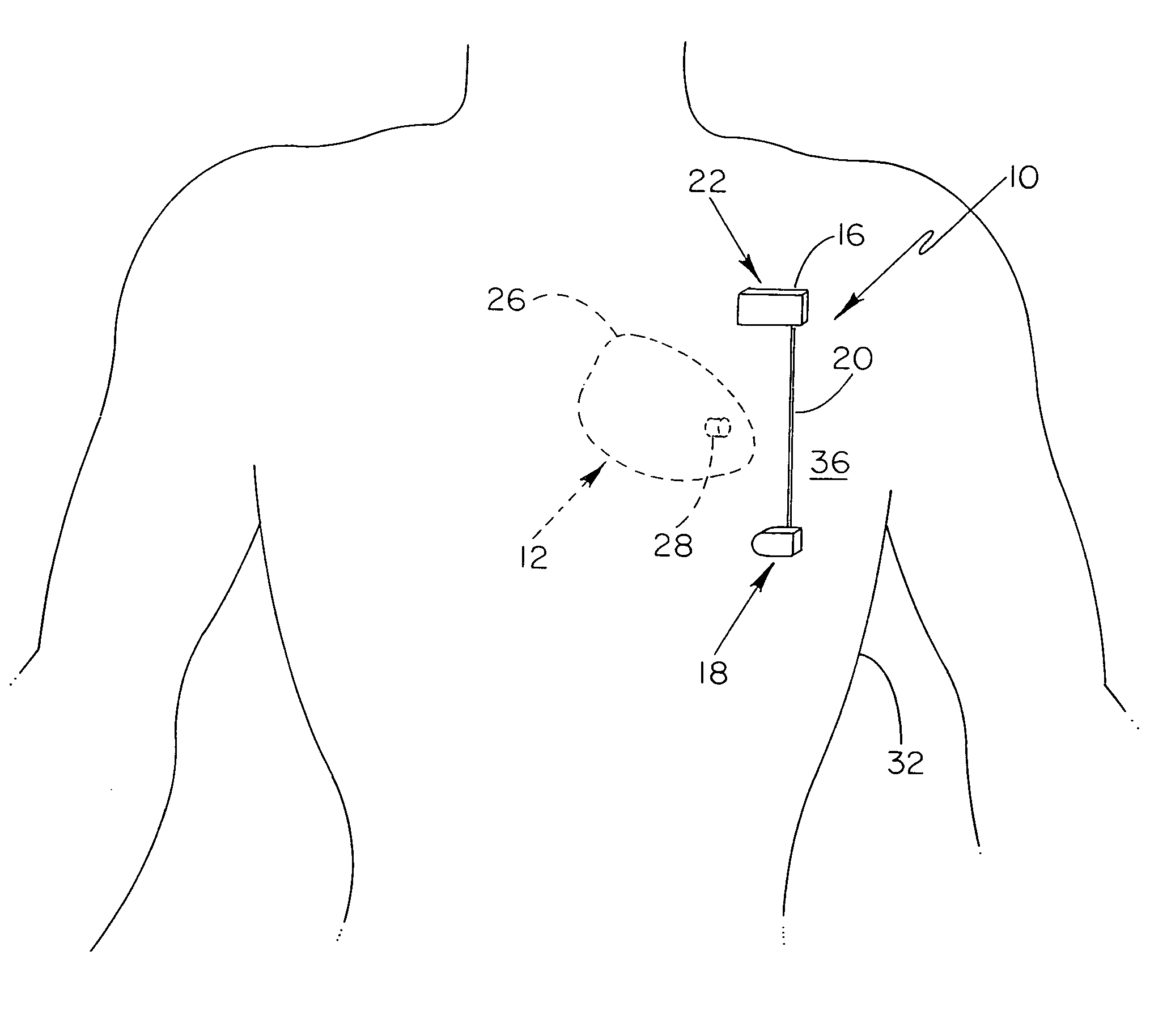 Anti-coagulation and demineralization system for conductive medical devices
