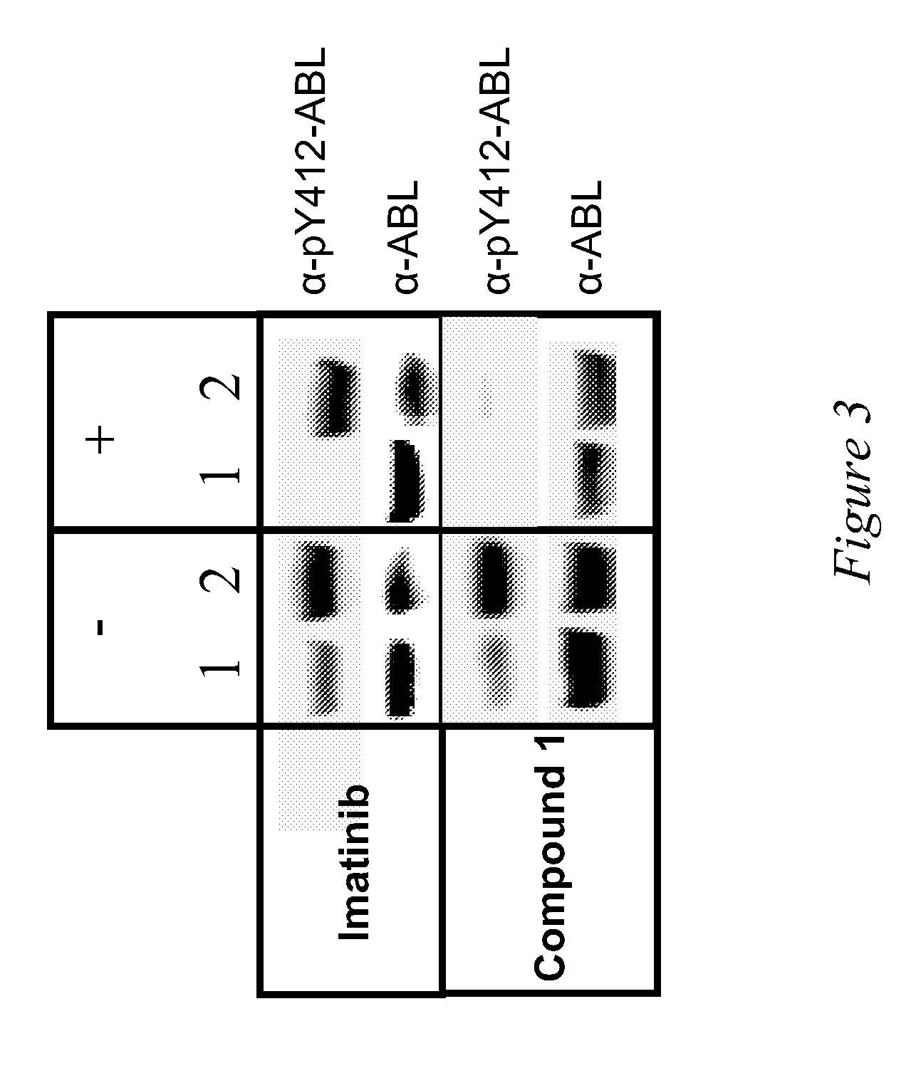 Use of a kinase inhibitor for the treatment of particular resistant tumors