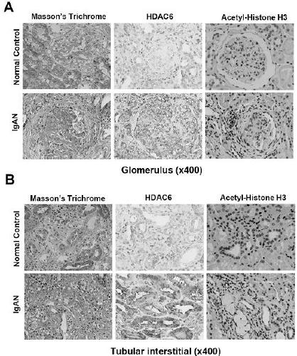 Application of histone deacetylase 6 in preparation of marker for assessing progression of renal function in IgA nephrotic patients