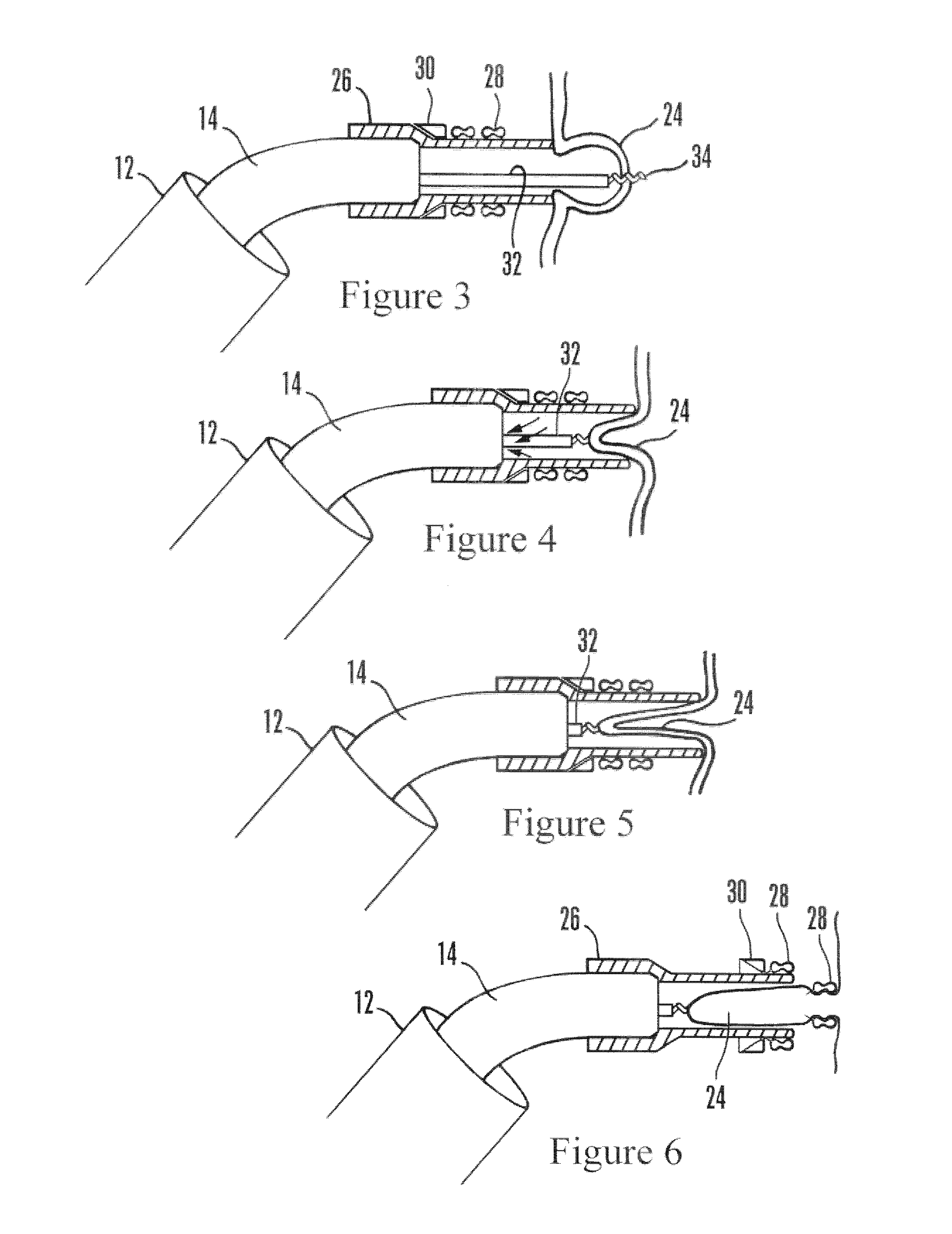 Devices and methods for securing tissue