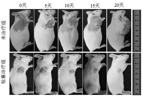 Ph-reducing double-responsive polymer embolic agent for catheter-free embolization of tumors and its synthesis