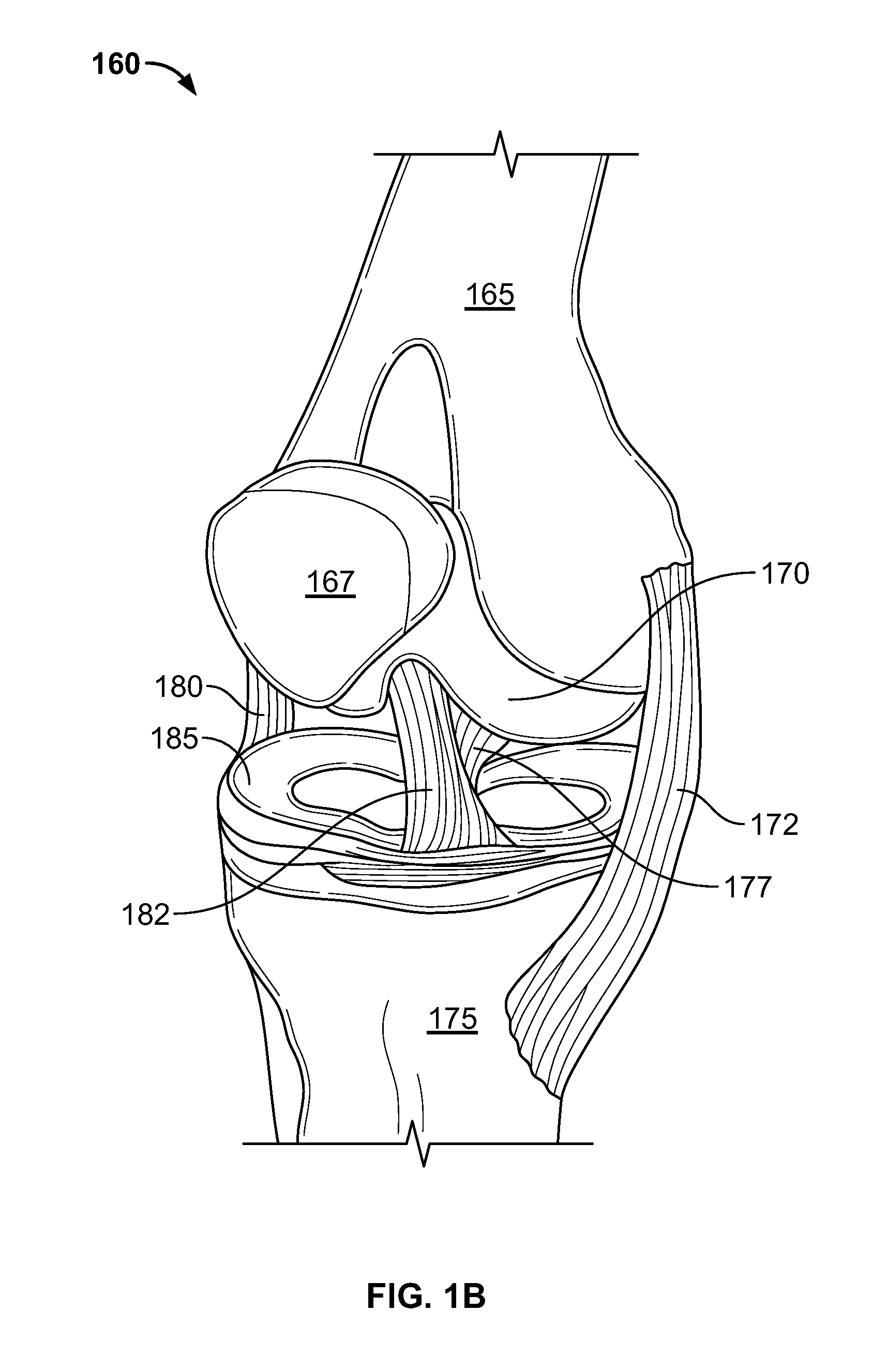 Systems and methods for treating human joints