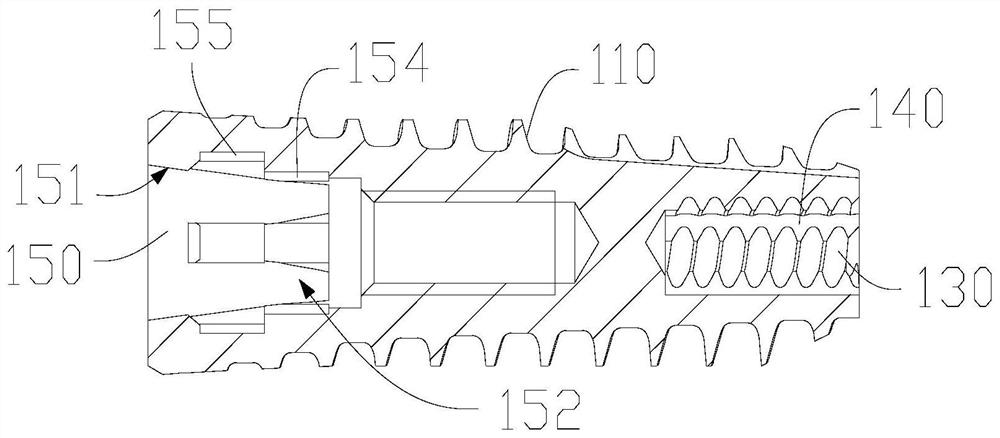 Implants and implant systems