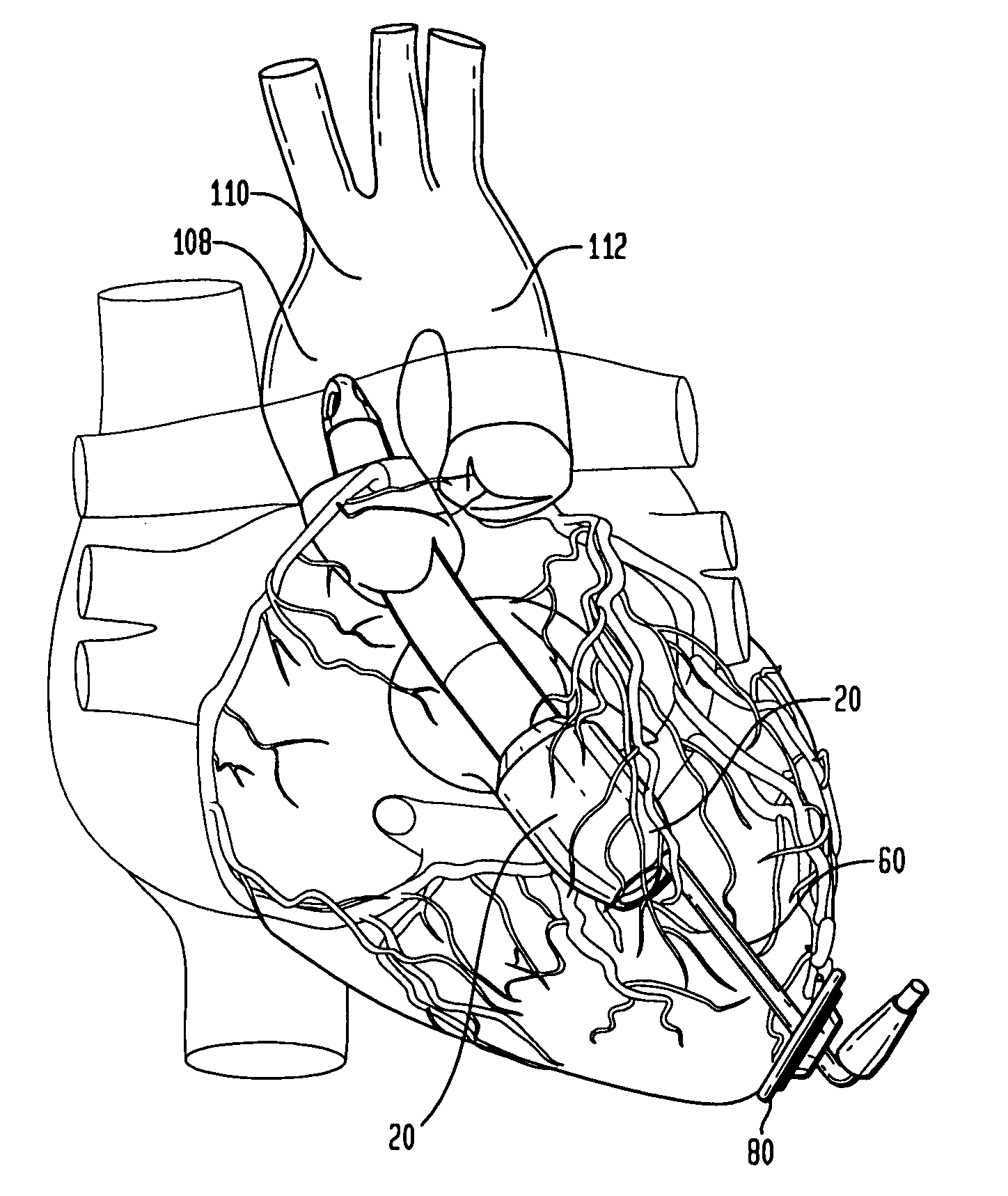 Ventricular assist device for intraventricular placement