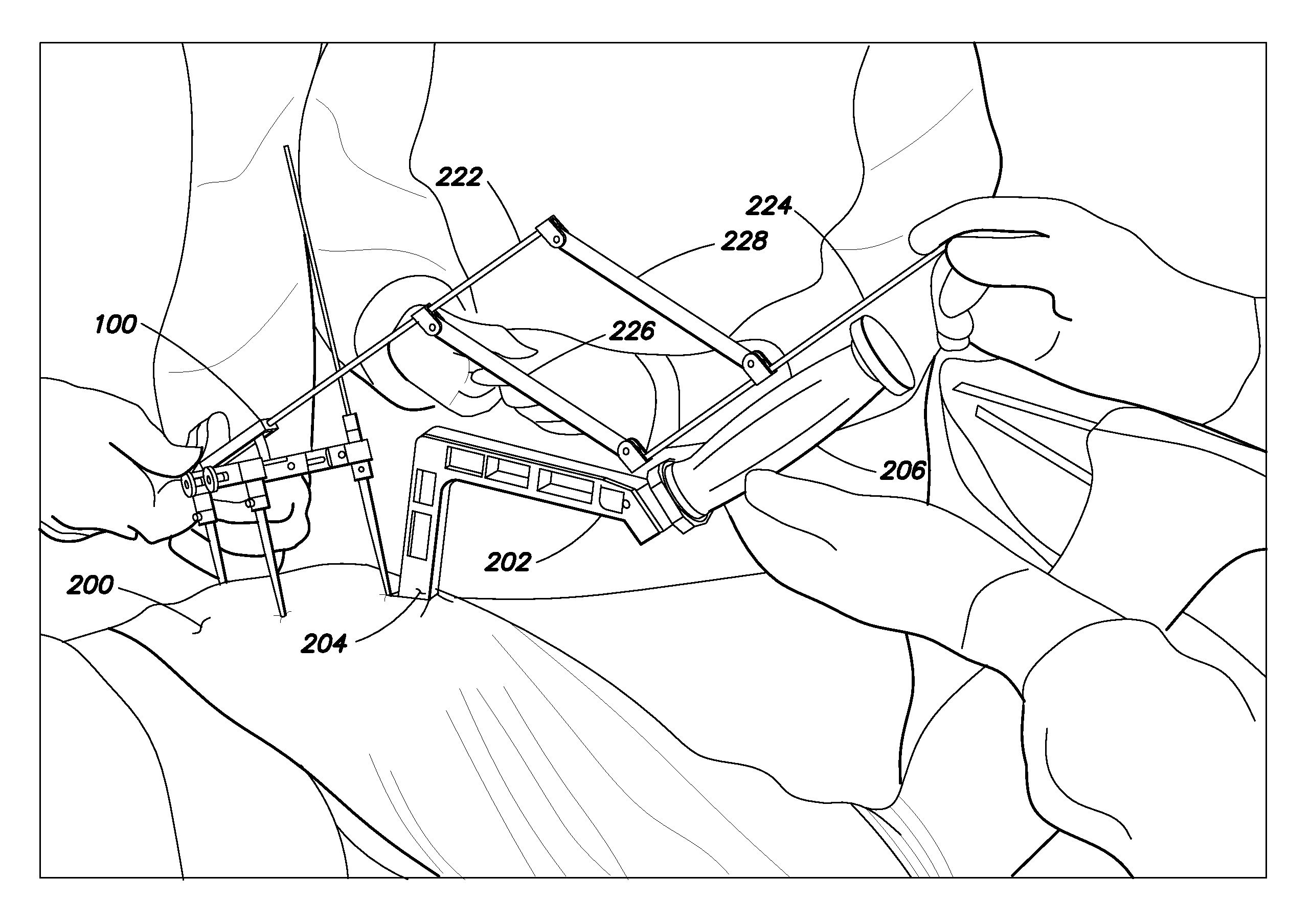 Guide for acetabular component positioning