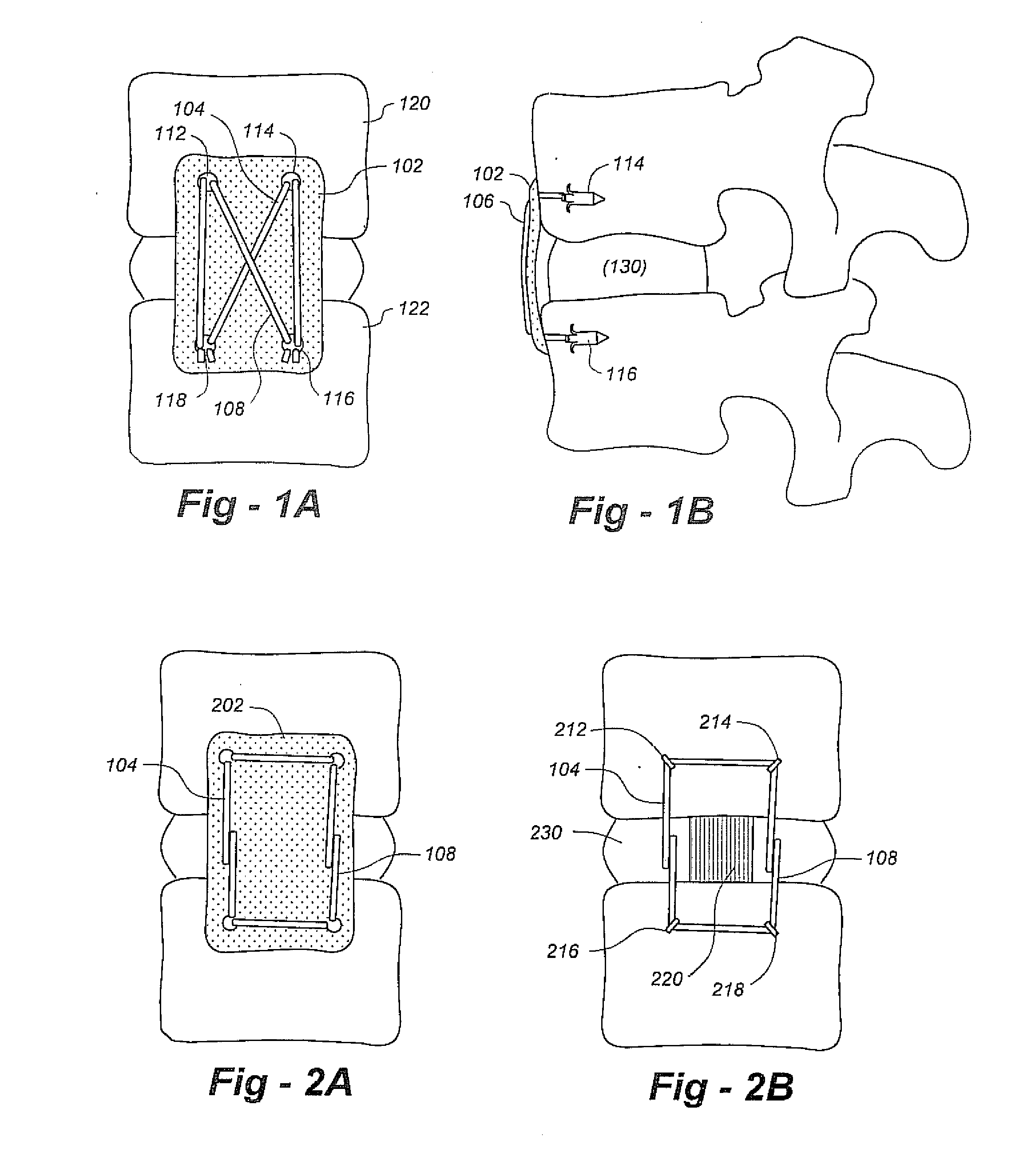 Methods and apparatus for repairing and/or replacing intervertebral disc components and promoting healing
