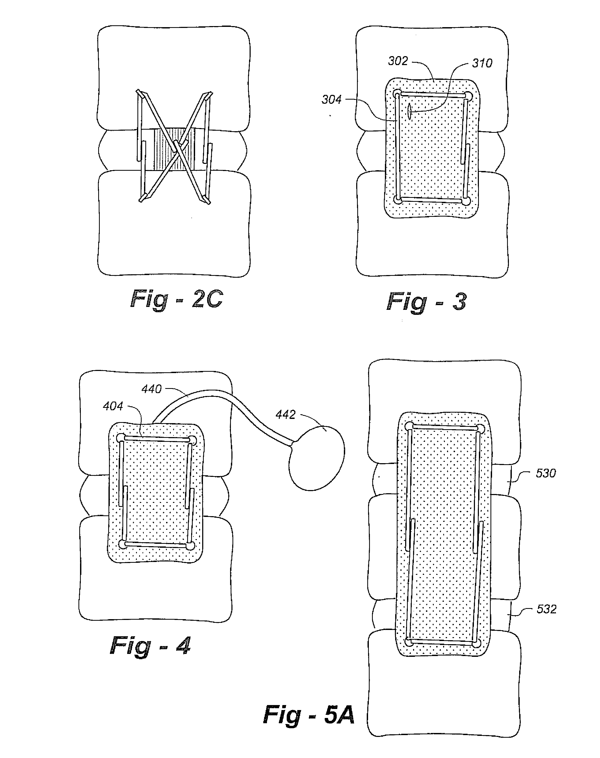 Methods and apparatus for repairing and/or replacing intervertebral disc components and promoting healing