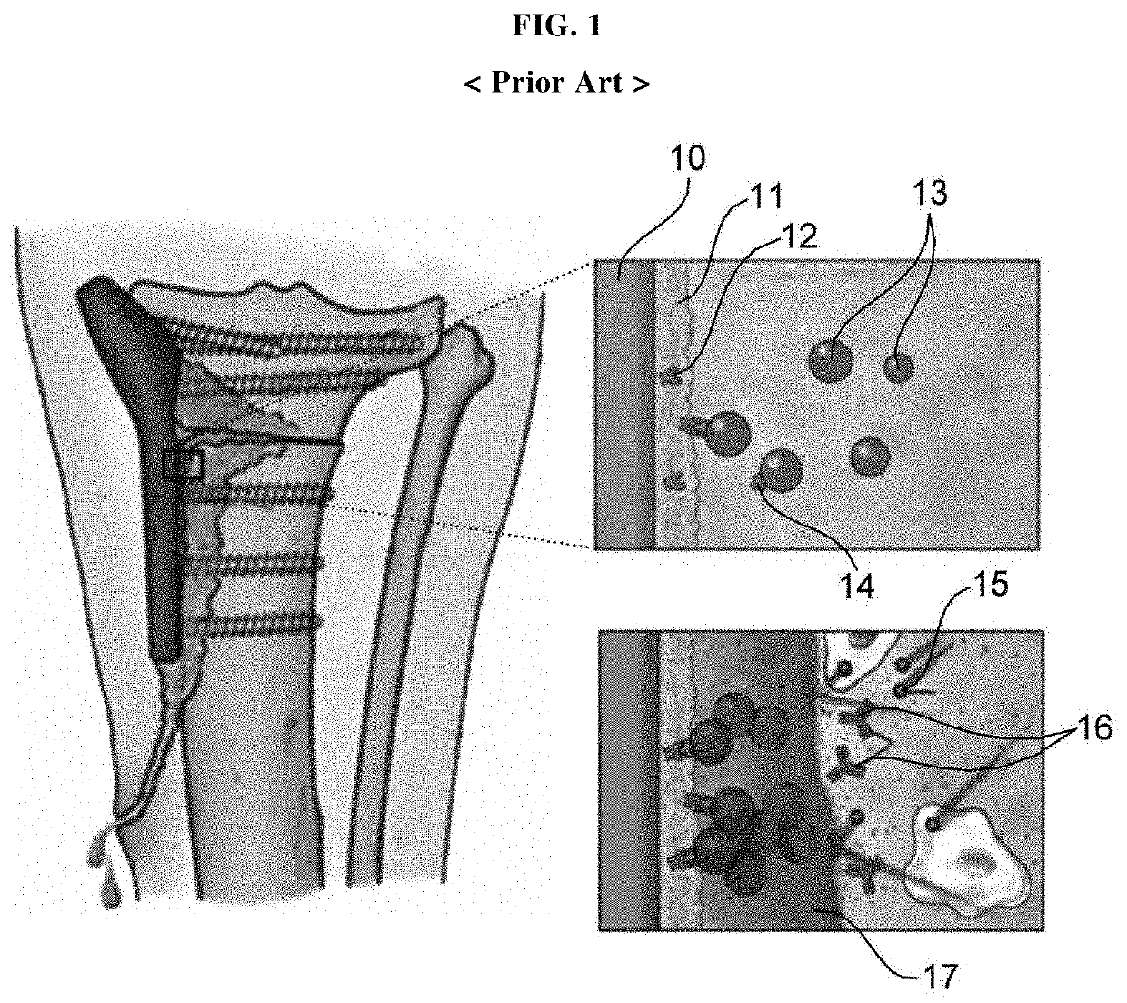 Surface coating structure of surgical prosthesis and method for modifying surface of surgical prosthesis using same