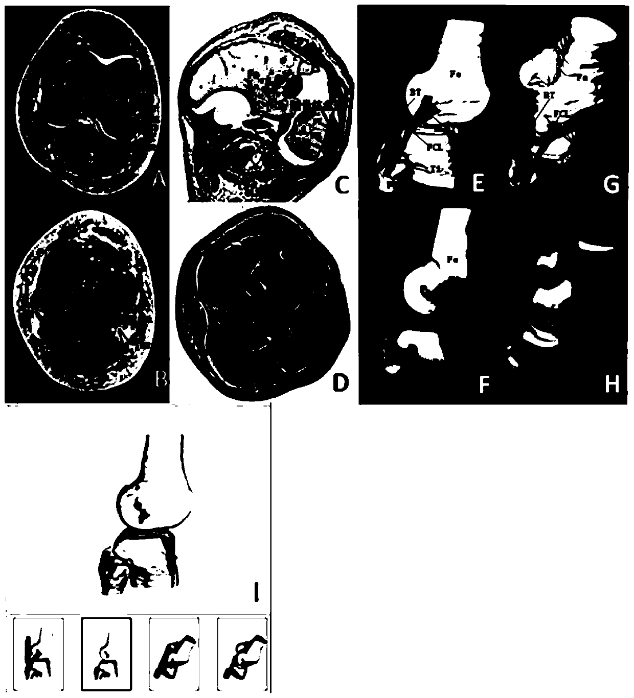 Morphological recognition and visualization method for tendon-bone joint part of knee joint posterior-lateral complex