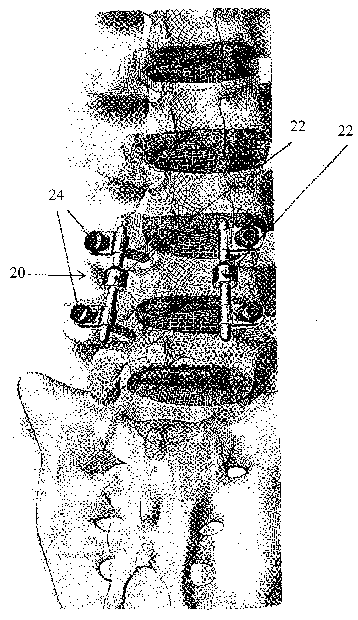 Spinal implant having a post-operative adjustable dimension