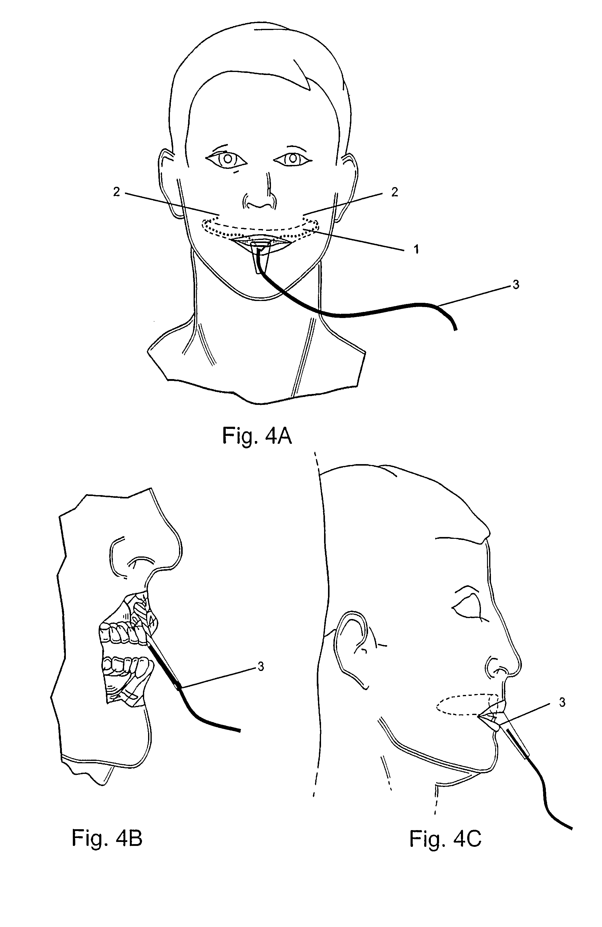 Device for preventing bruxism