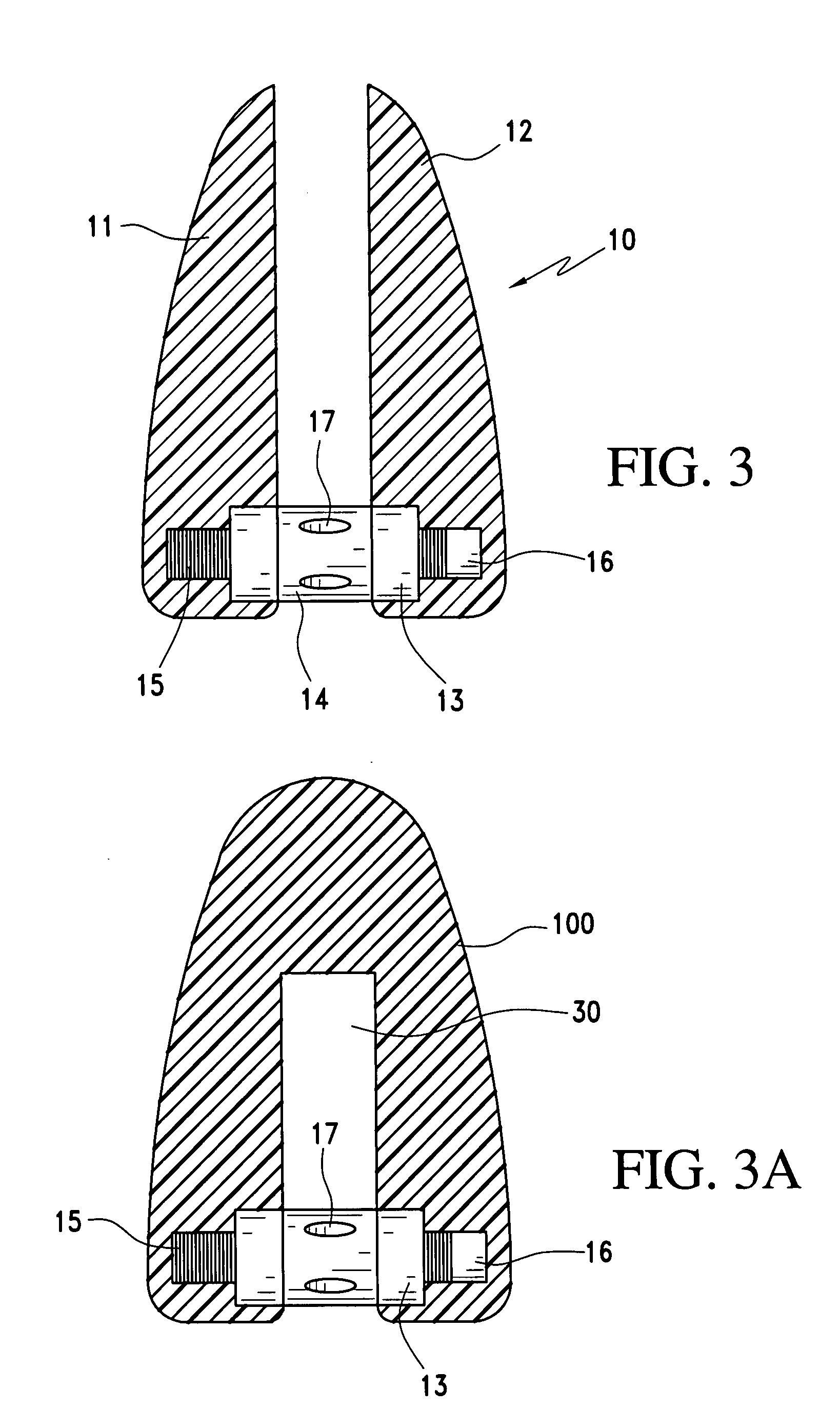 Orthonostric device and method of forming the same