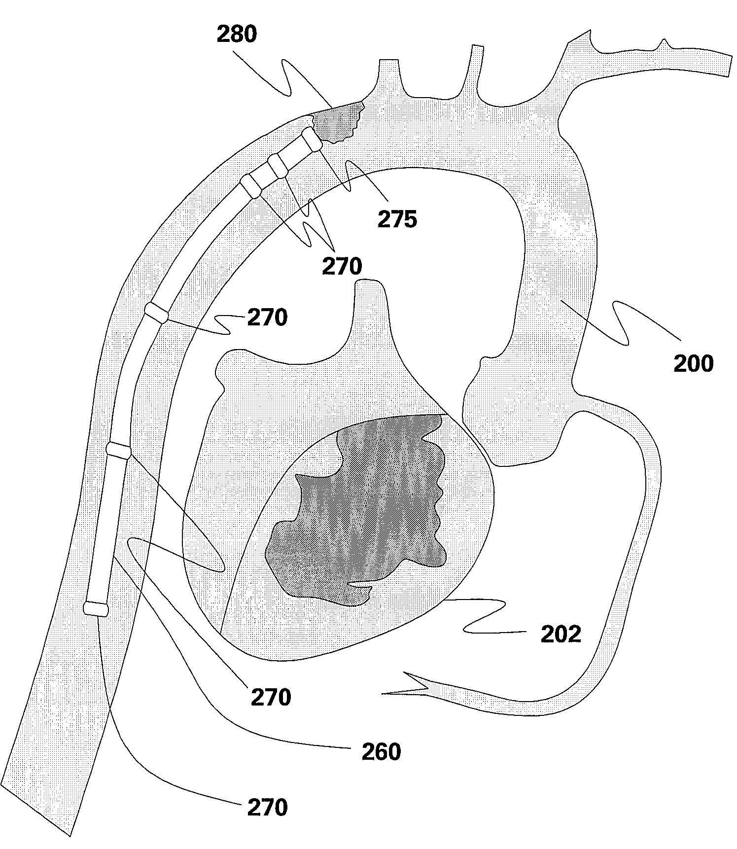 System and method for interventional procedures using MRI