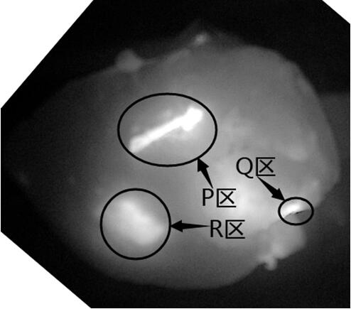 Application of Mitoxantrone Hydrochloride Injection for Futashu Tracing as a Fluorescent Tracer and a Fluorescent Camera Device for It