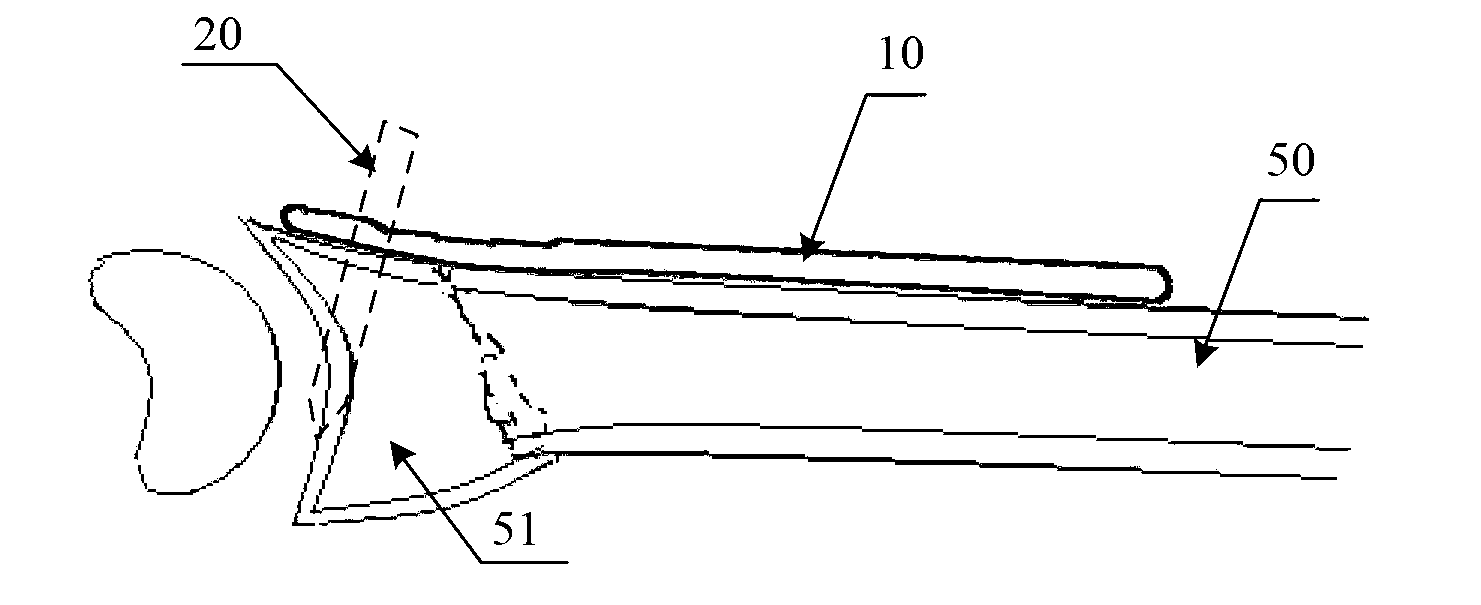 Distal radius fracture fastener with angle correcting structure