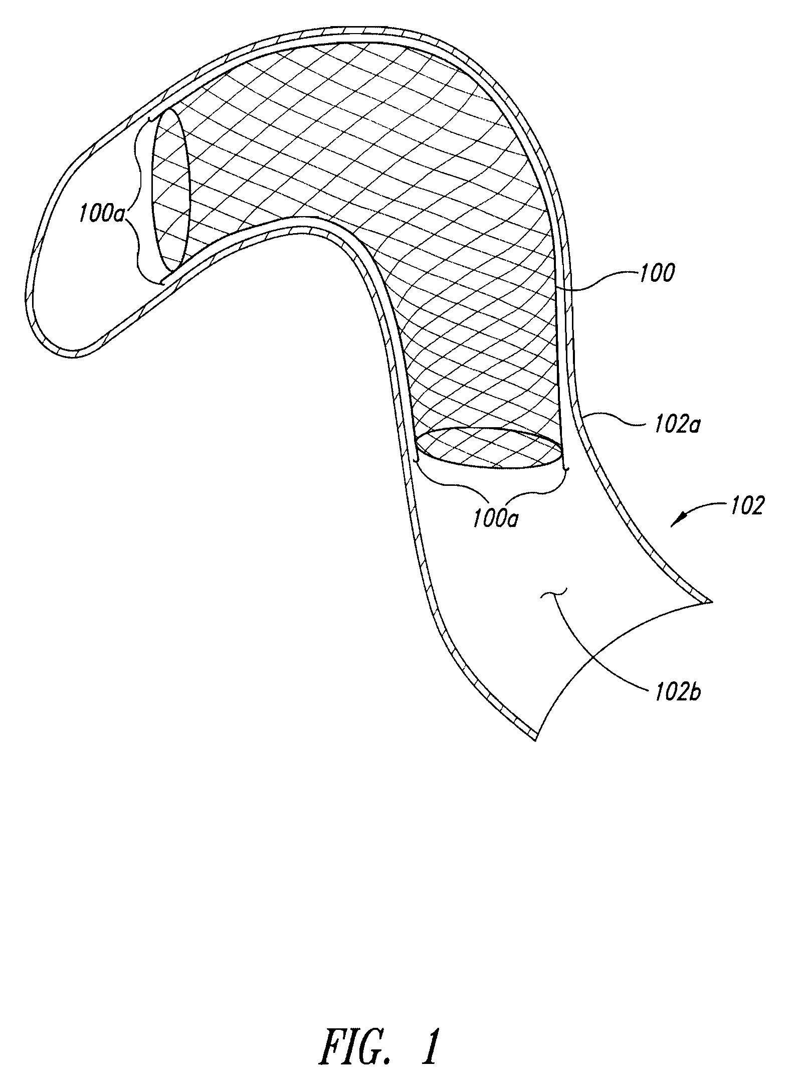 In vivo inflatable structures, for example to expand stents