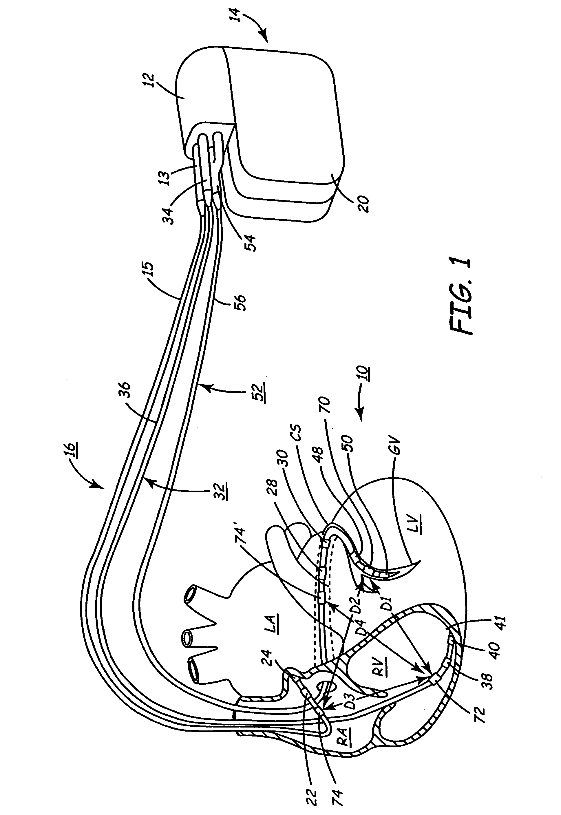 Implantable medical device employing sonomicrometer output signals for detection and measurement of cardiac mechanical function